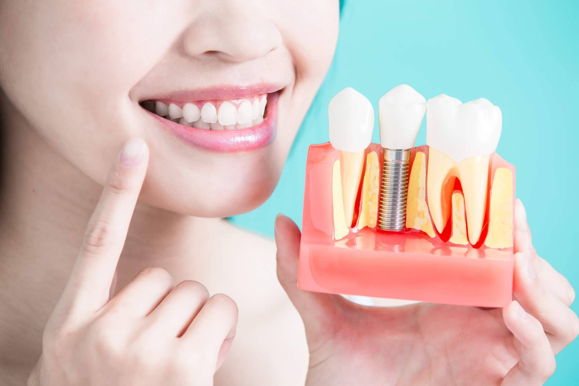 El procedimiento de implante dental de titanio en Sevilla que ofrece Clínica Dental Helident