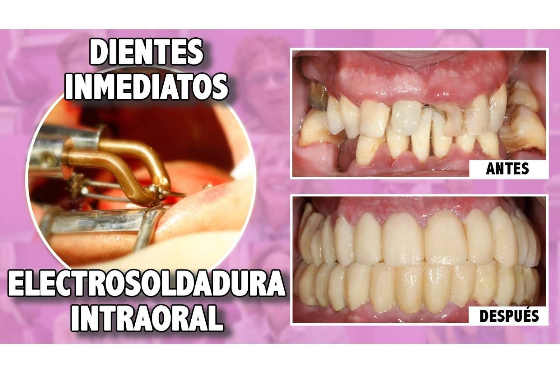La técnica de implantes con dientes inmediatos del Dr. Ismael Soriano ofrece numerosas ventajas a los pacientes