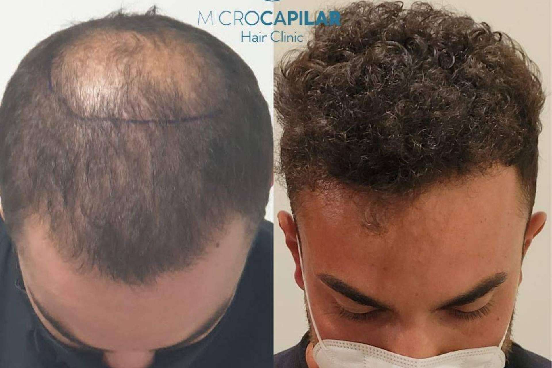 En qué lugar es posible realizarse un injerto capilar con máxima extracción folicular, Microcapilar Hair Clinic