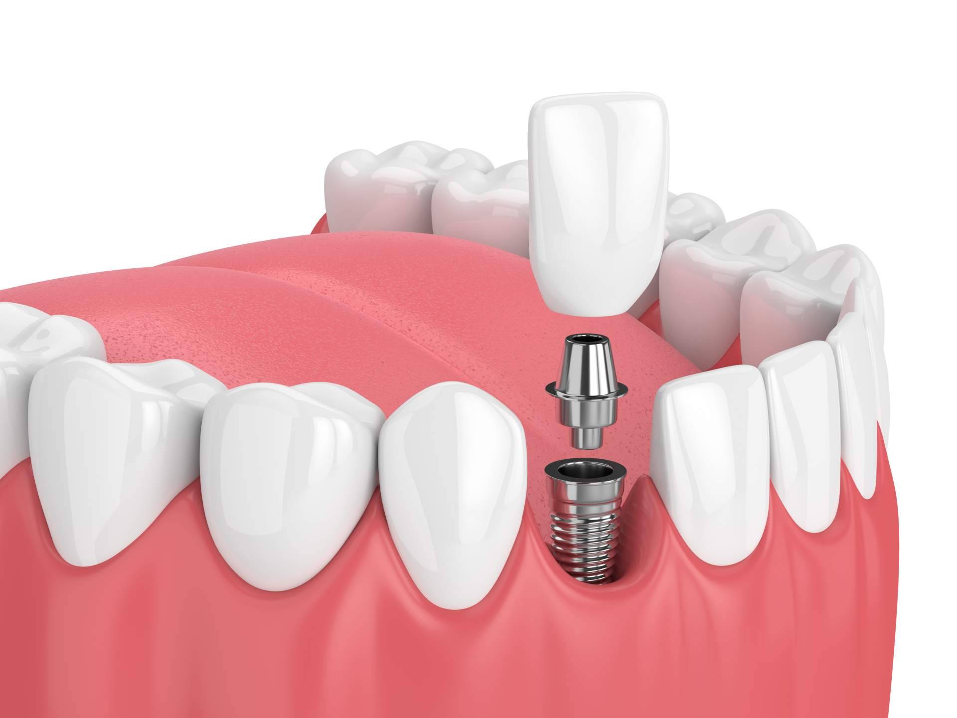Clínicas Qualident y sus implantes dentales innovadores en Hospitalet
