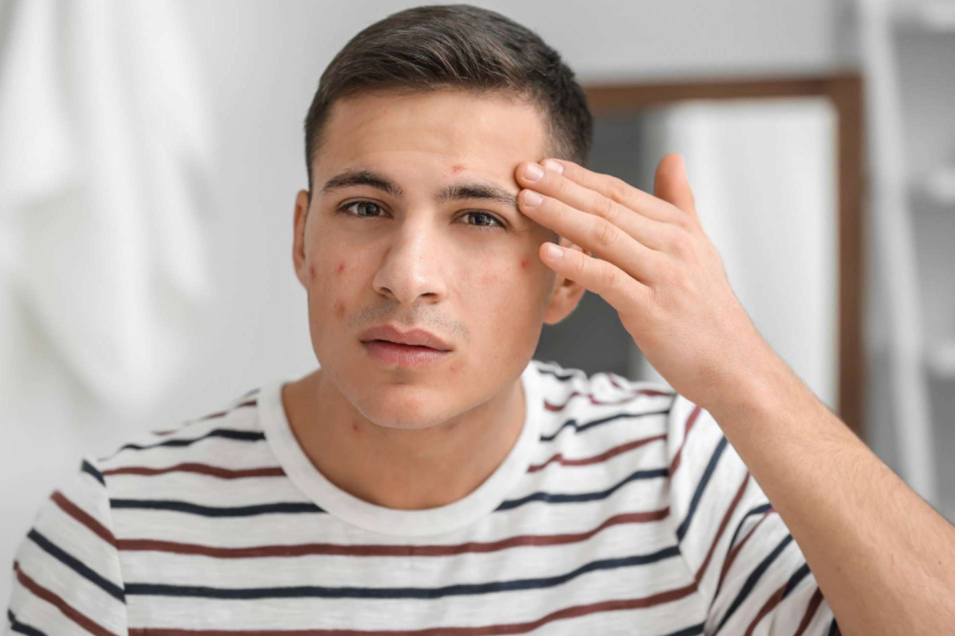 Los beneficios del tratamiento contra el acné de Bėyo Beauty