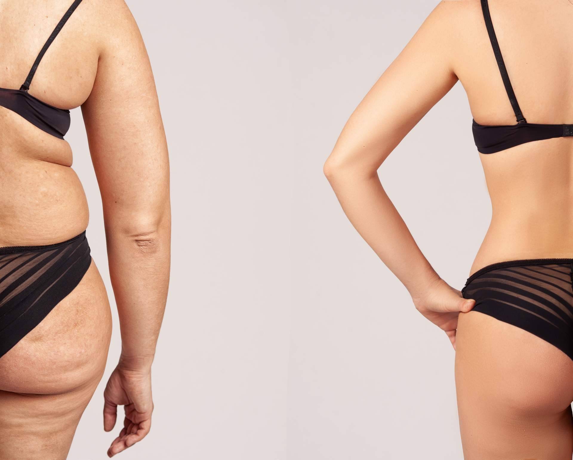 El tratamiento de Velashape III de la Dra. Rigo
