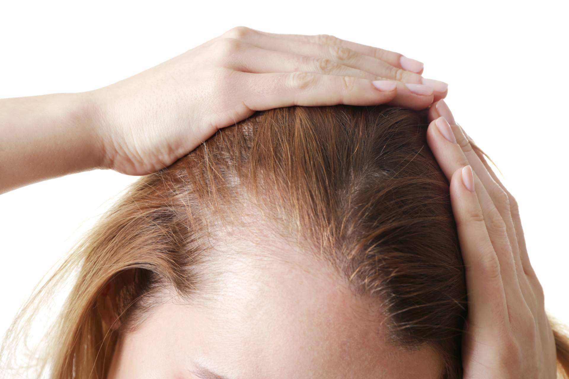 Las mujeres también pierden el pelo, por Clínica Femme