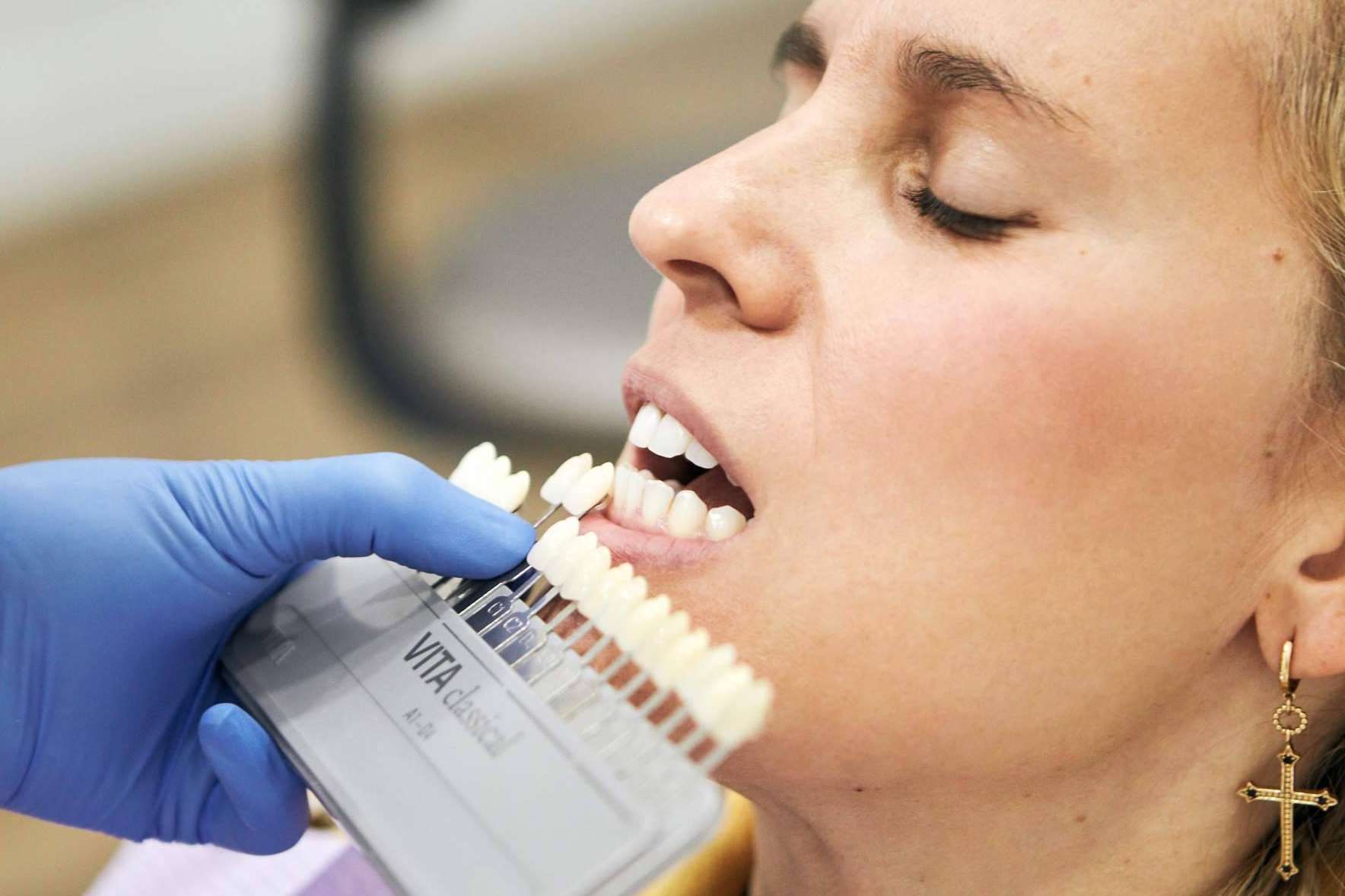 Optar por la rehabilitación estética con las carillas dentales