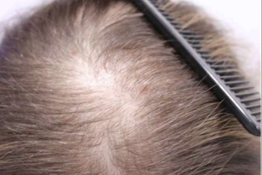 Tipos de alopecia femenina y métodos para combatirla, por Injermur