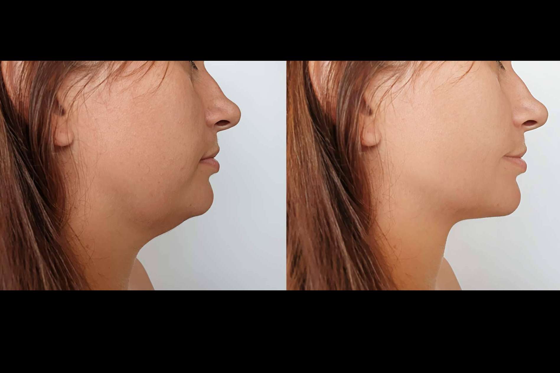 Es posible eliminar la papada y la flacidez facial gracias al lifting láser, con Clínica Femme