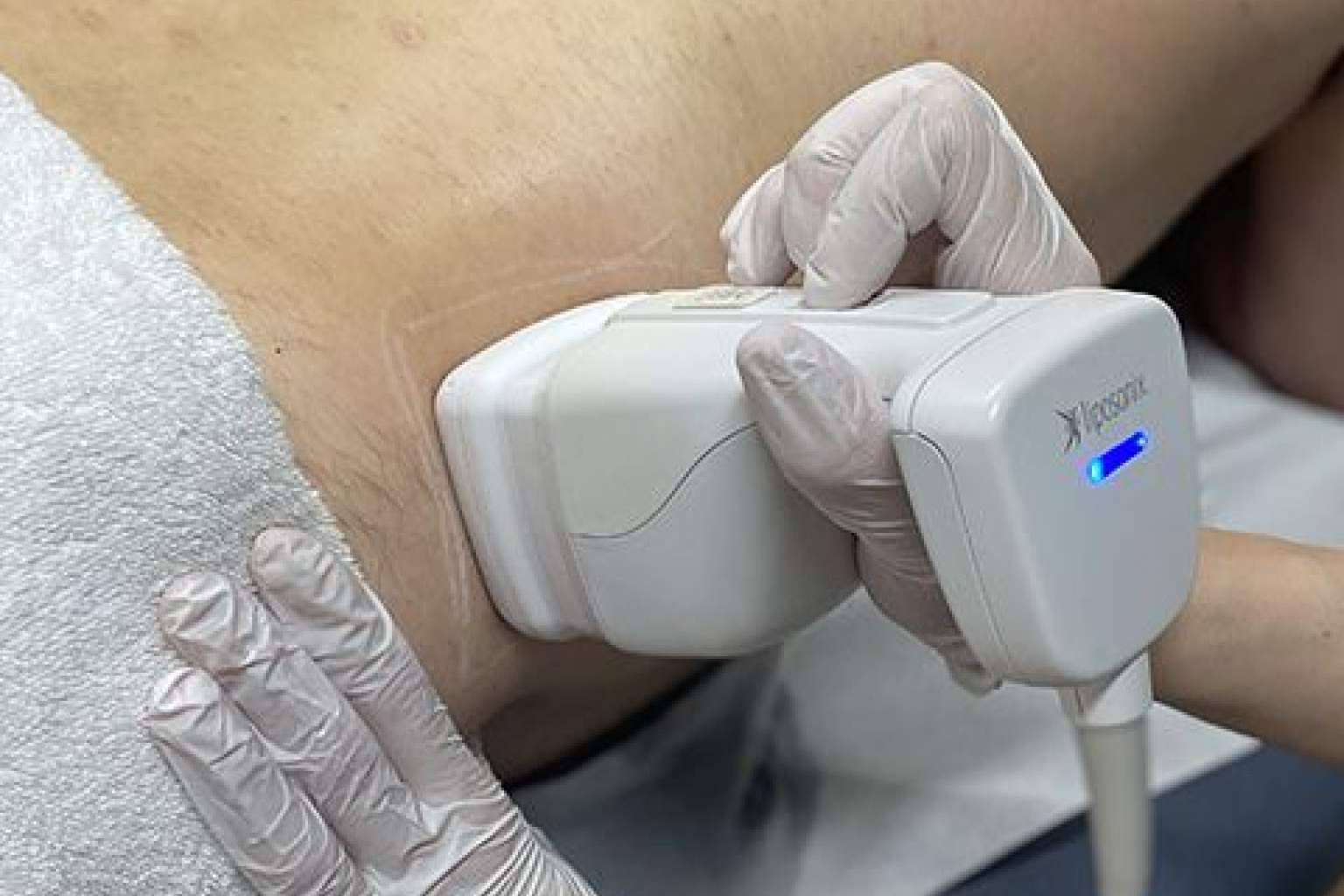 Liposonix, un tratamiento reductor de la grasa localizada sin dolor ni cirugía