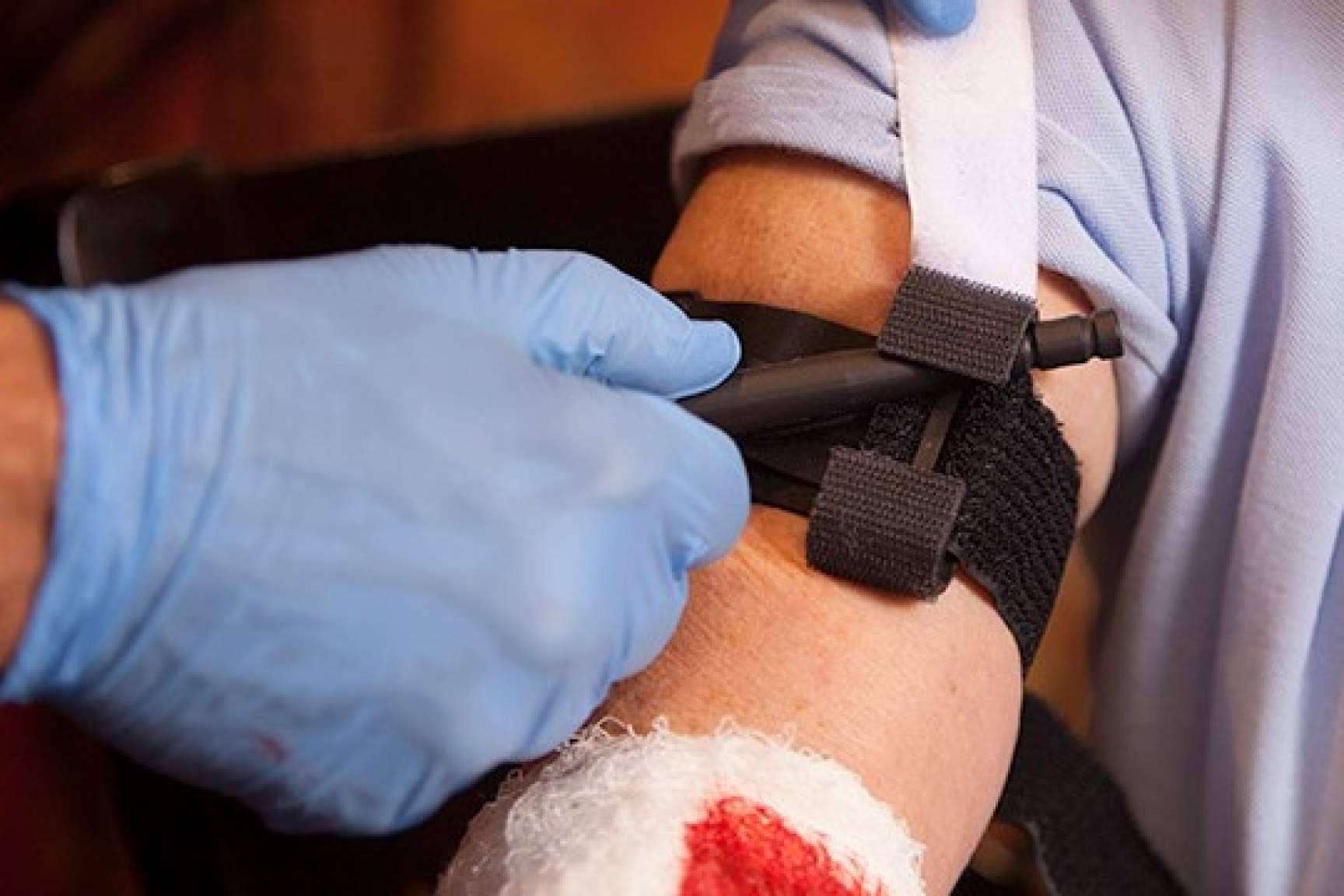 ¿Cuándo y cómo hacer un torniquete?