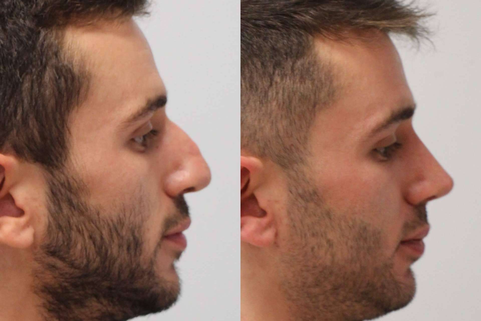 Un avance médico que está disponible en Valladolid y Santander, la rinoplastia ultrasónica