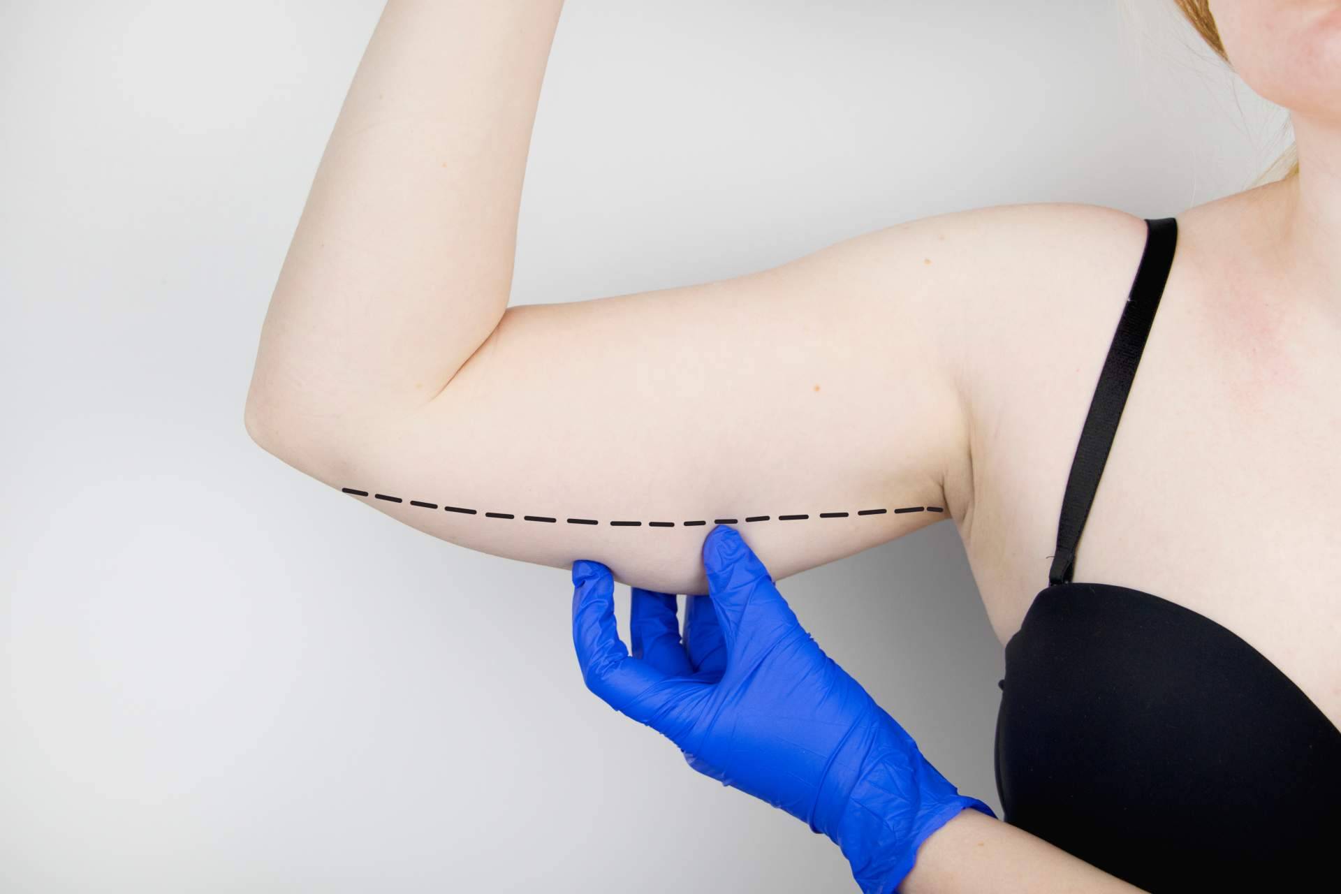 Cryolipoescultura, por BioSalud Canarias