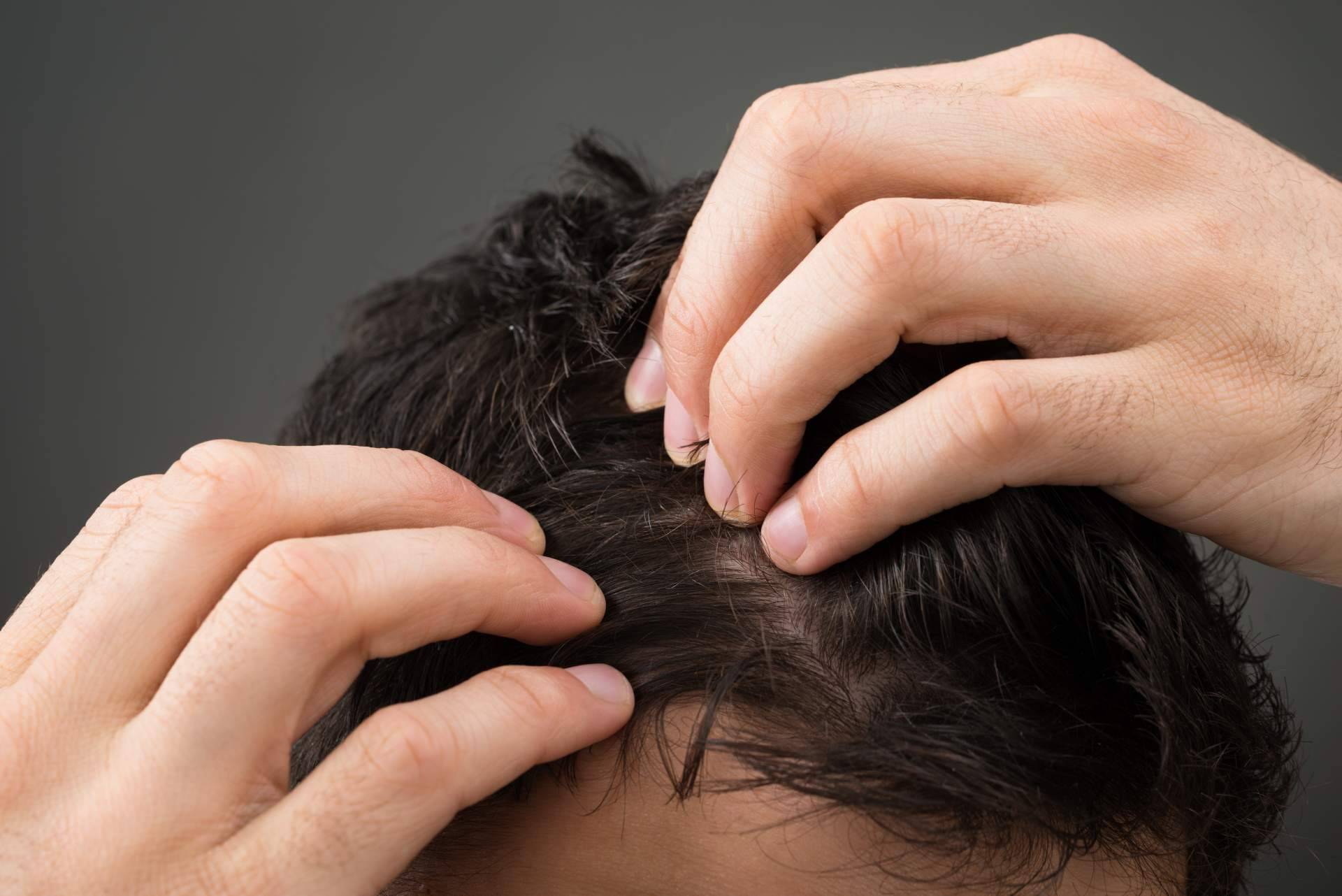 ¿En qué consiste la micropigmentación capilar?, por Élite Capilar