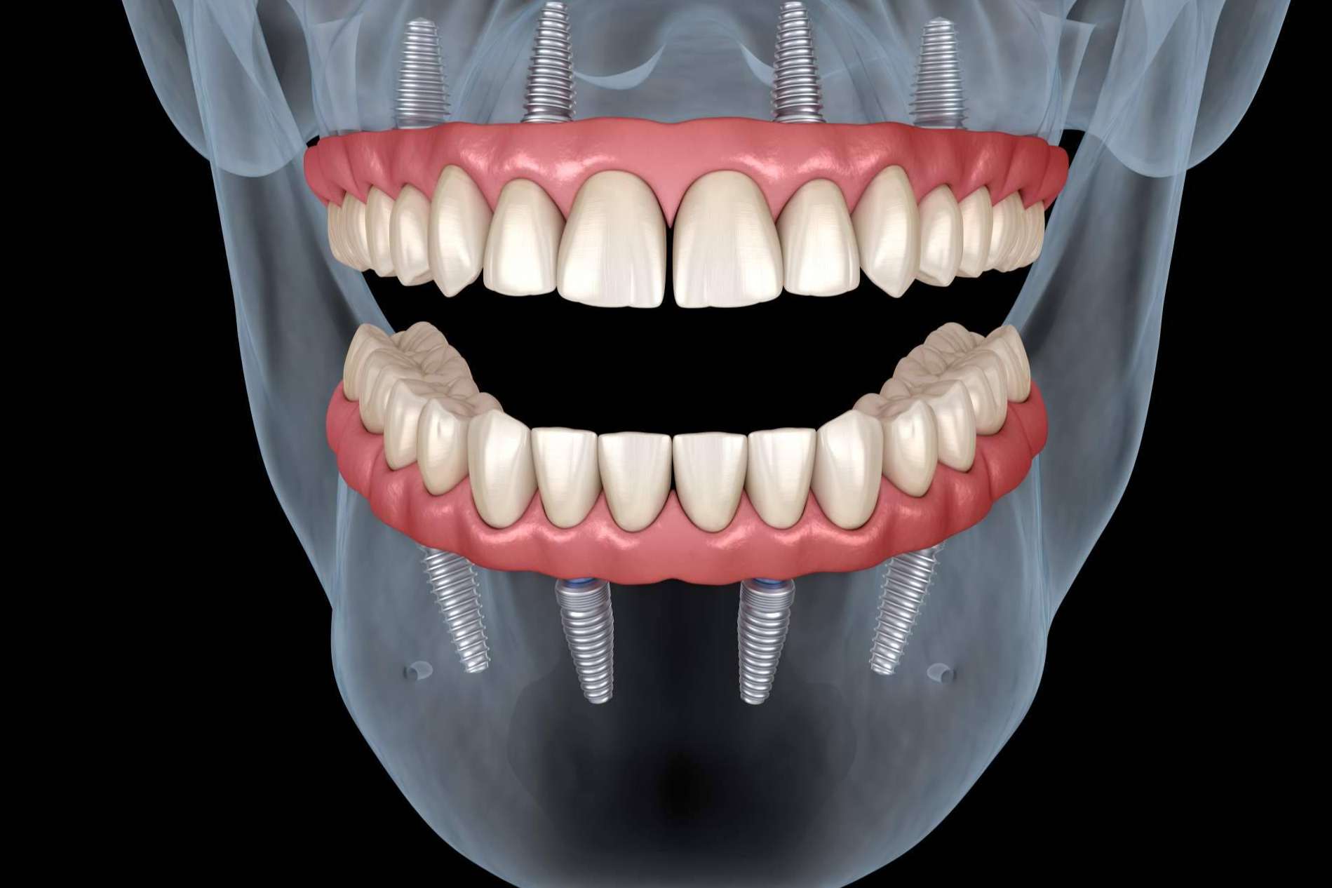 Los instrumentos para la óptima confección de las prótesis dentales de Precisión Médica Dental