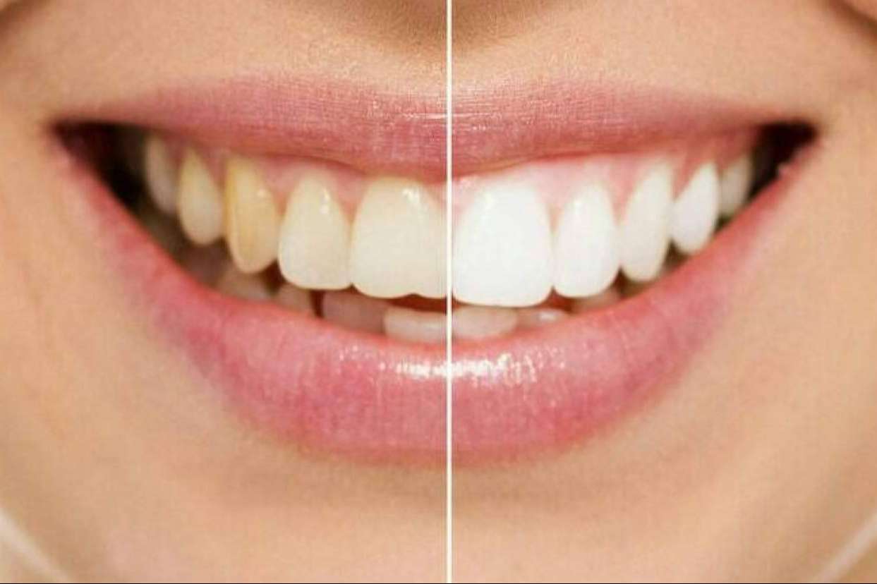 Los servicios de blanqueamiento dental que realiza Cleardent