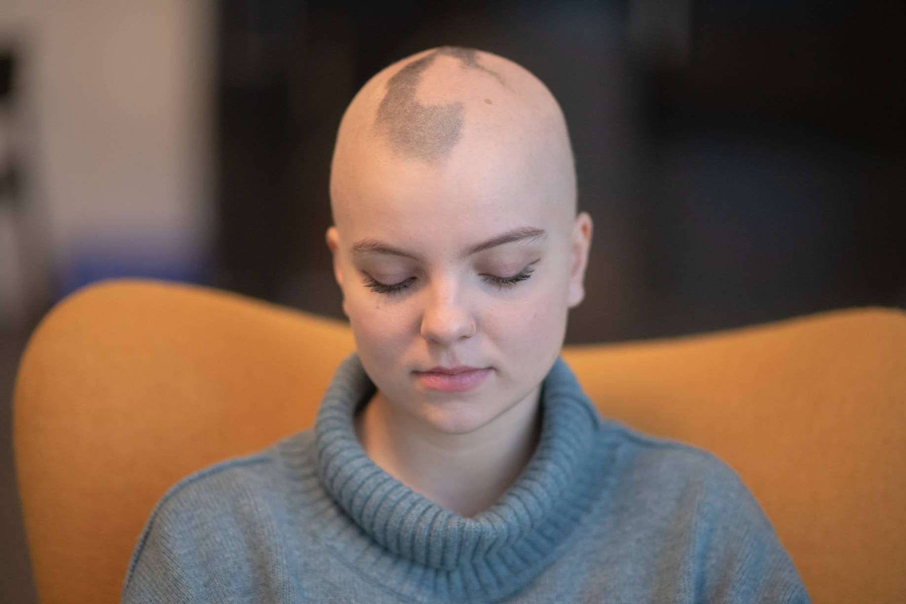 Las prótesis capilares son una alternativa a la pérdida de cabello