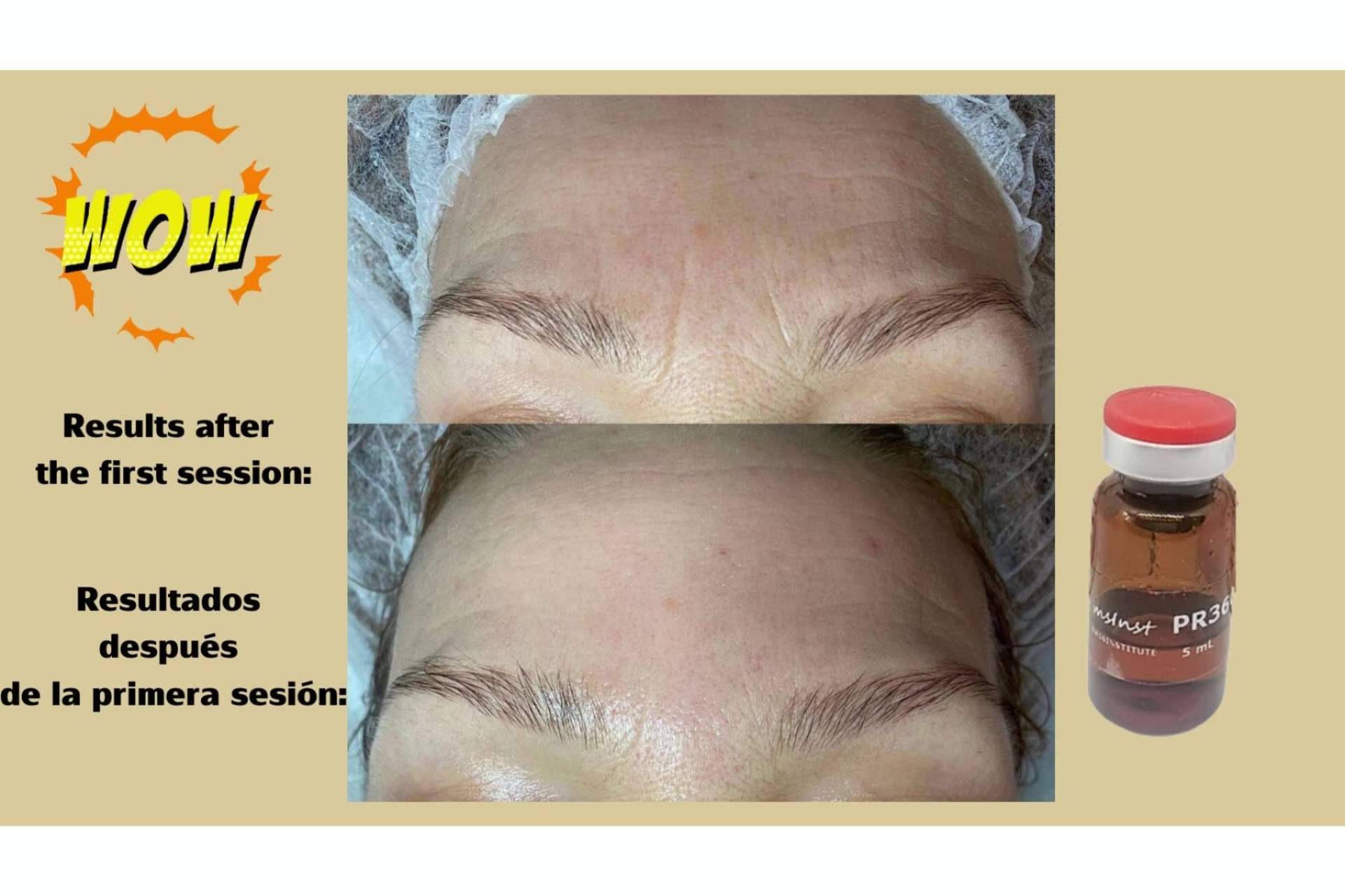 ¿Qué es el peeling químico? ¿Es recomendable realizárselo?