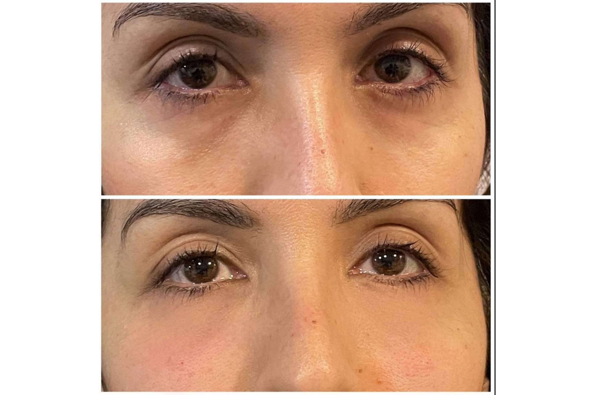 Cecilia Arthur permite despertar la mirada con su tratamiento de relleno de ojeras con ácido hialurónico