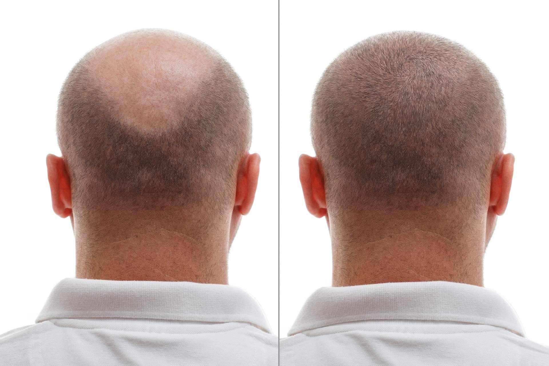 ¿Por qué el trasplante de pelo en la coronilla es la solución definitiva para la alopecia en esta zona?