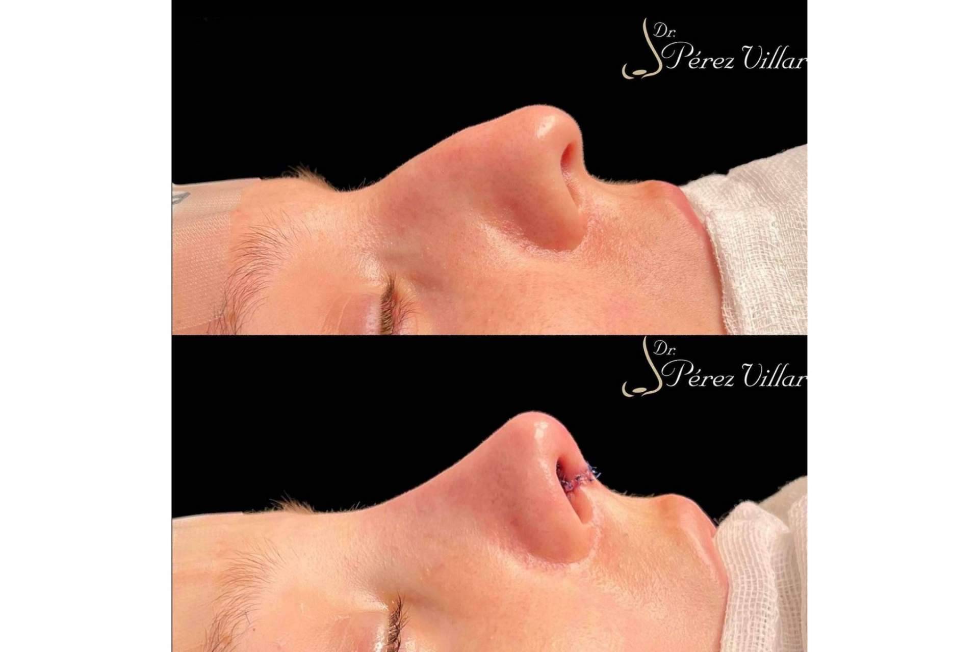 ¿Por qué la rinoplastia ultrasónica de preservación es una técnica cada vez más presente en el mundo de la estética?, por el Dr. Álvaro Pérez-Villar Bonet