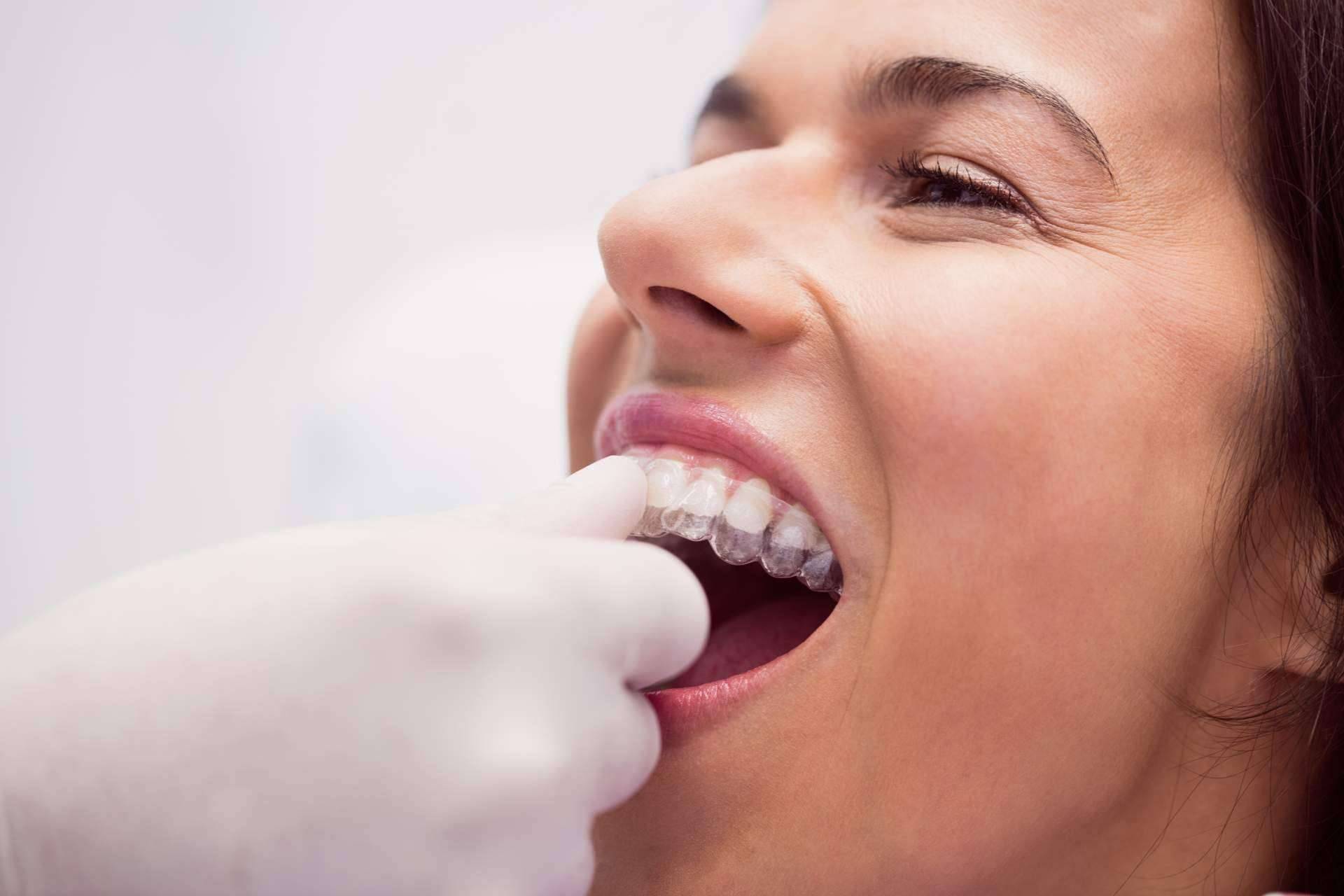 Clínica Dental Delgado expone toda la información importante sobre la ortodoncia para adultos