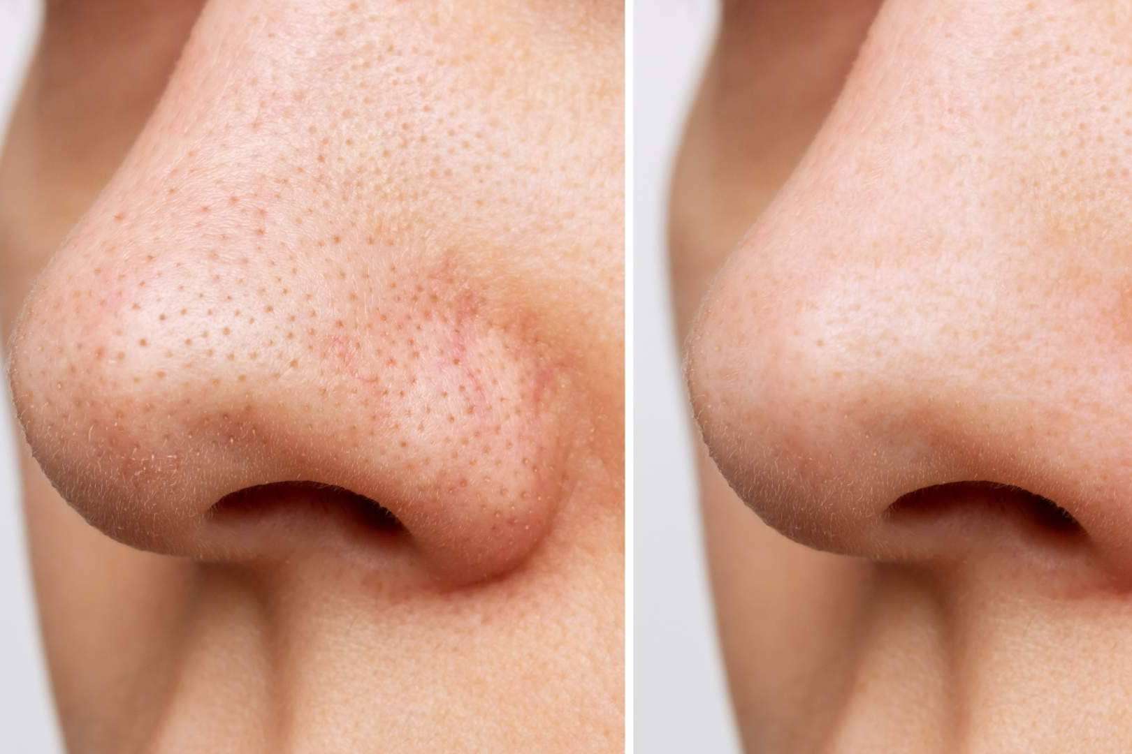 ¿Cómo tratar los puntos negros?, los productos efectivos de JK Natural Care