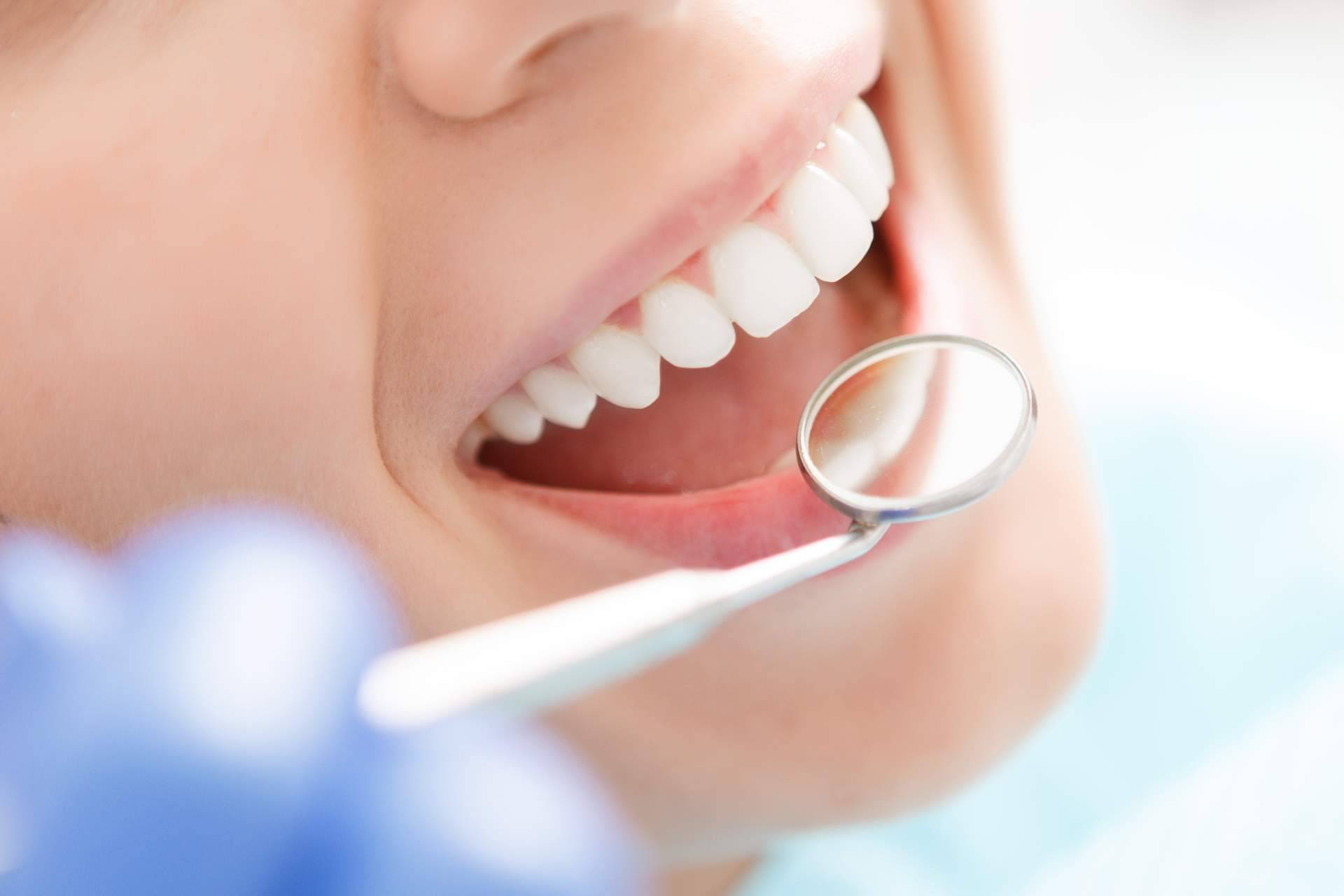 ¿Qué es el blanqueamiento dental?, por Bucalia