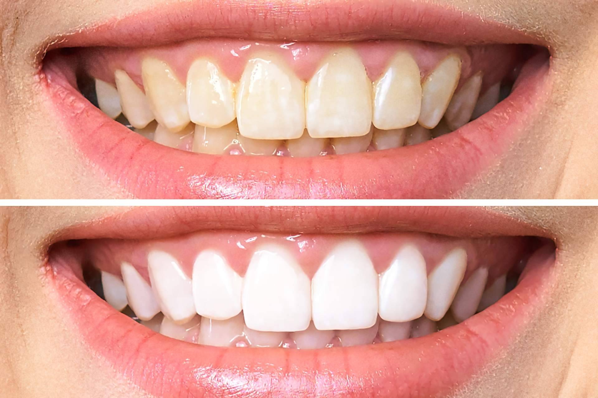Clínica Dental Delgado indica cómo se realiza un blanqueamiento dental