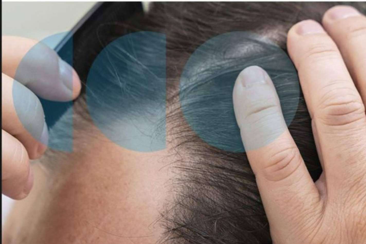 ¿Por qué la caída de cabello estacional viene más fuerte este año?