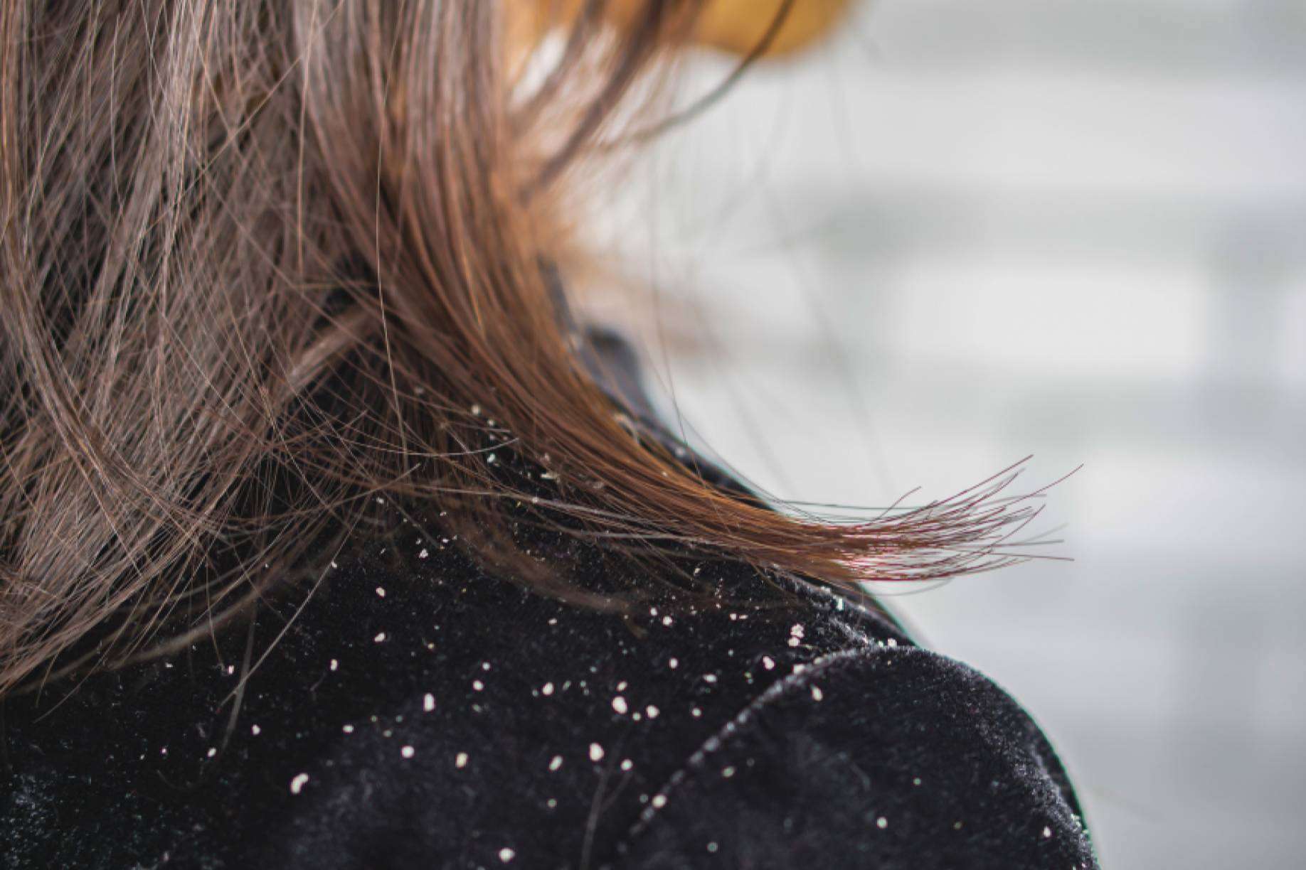 ¿Es culpable la caspa de la caída del cabello?