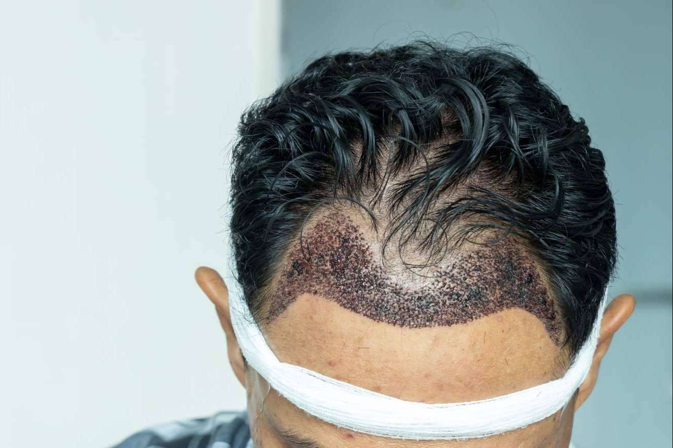¿De qué depende el éxito de un injerto capilar?, según MC360