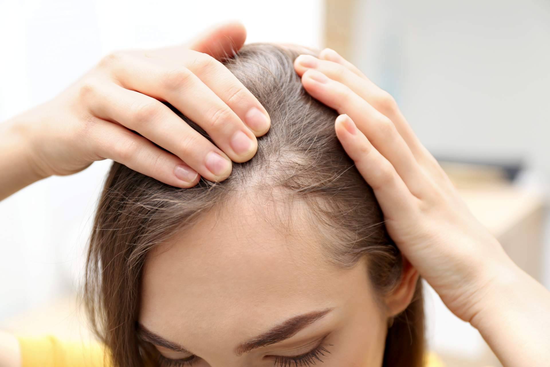 Capilar Innovation Clinic, especialistas en cualquier tipo de alopecia femenina