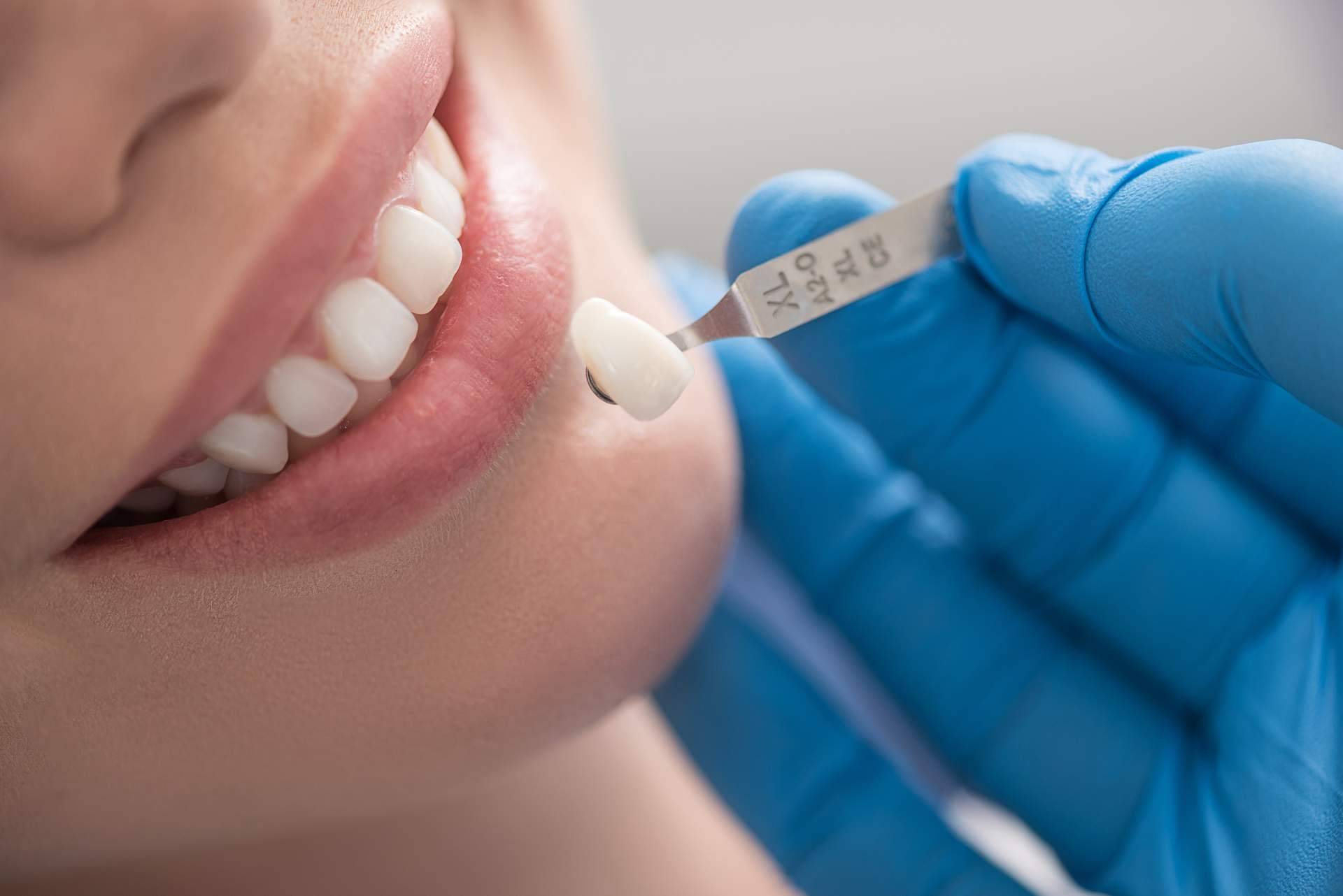Expertos en rehabilitación oral mediante coronas dentales, con Clínica Dra. Elena Serrano