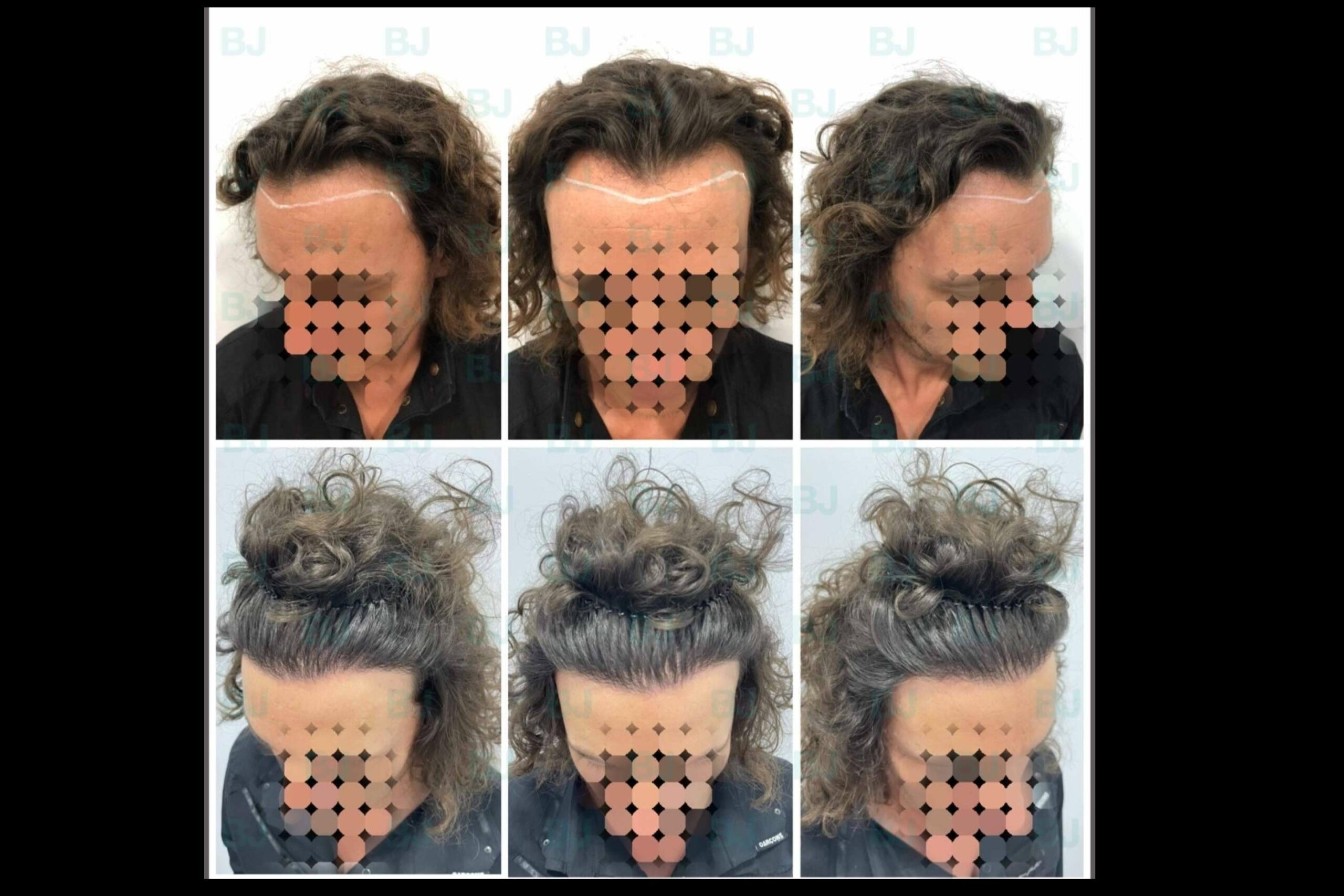 El Dr. Bruno Jacobovski utiliza las técnicas más modernas a la hora de realizar un tratamiento capilar