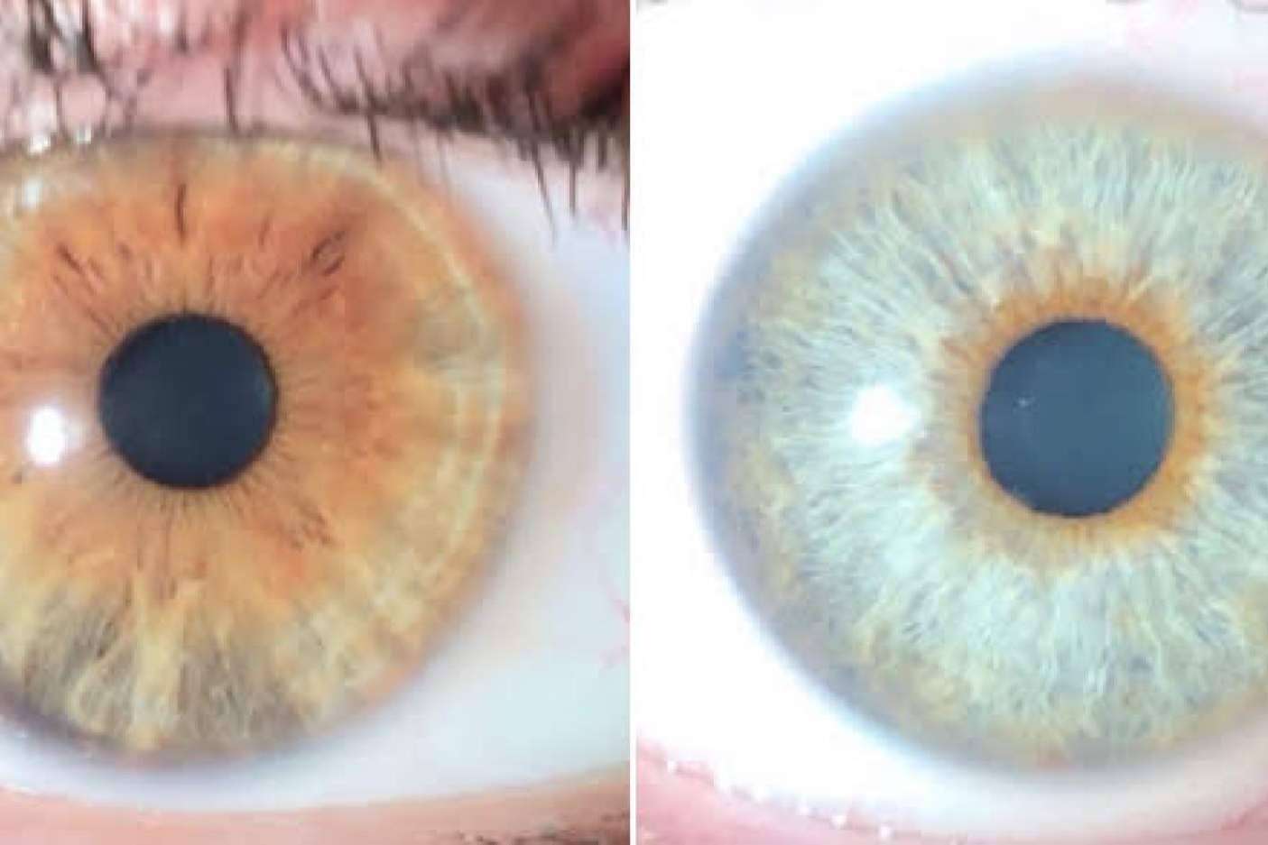 Los avances en las operaciones de cambio de color de ojos con láser, con Clínica Eyecos