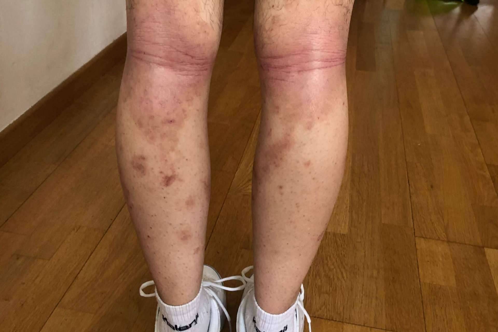 Acupuntura y fototerapia, tratamientos para los problemas de la piel con Nüwa