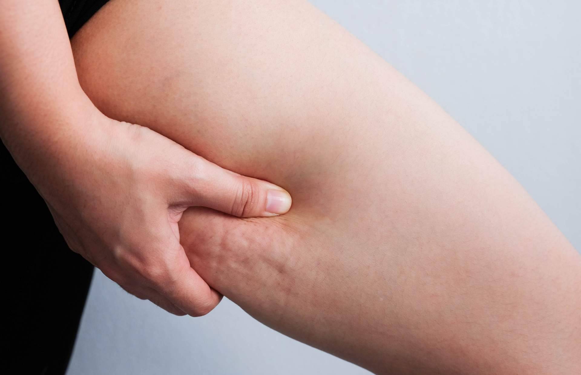 Vacuslim 48, tratamiento corporal para tratar y reducir la celulitis ¿Realmente funciona?
