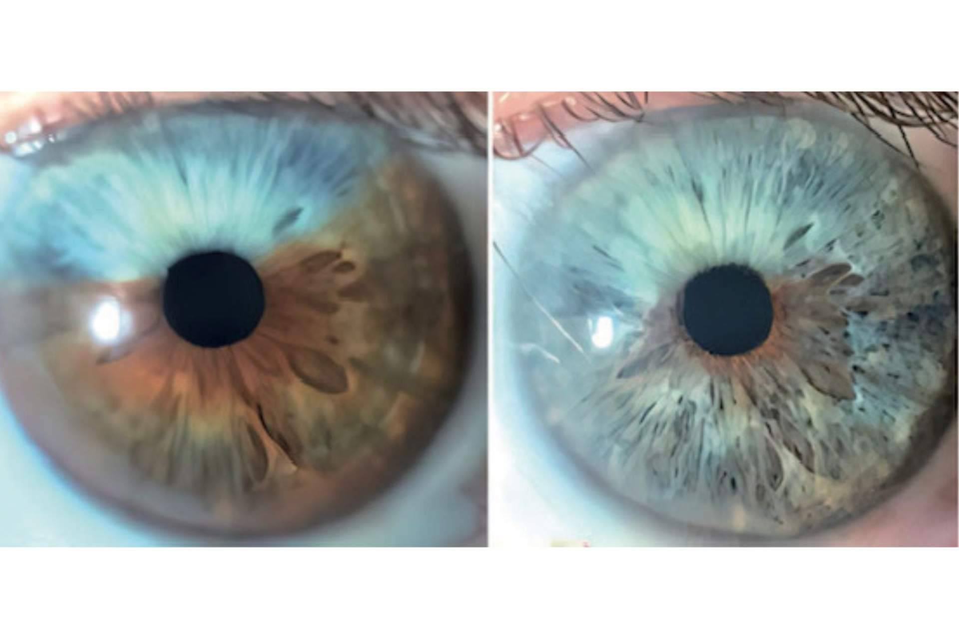 ¿Los heterocromías y los nevus del iris pueden ser tratados con láser? Clínica Eyecos