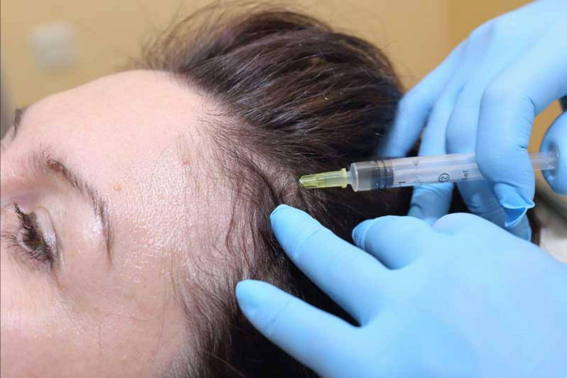 Conocer las ventajas de realizarse un tratamiento de mesoterapia capilar de IMD para recuperar las condiciones óptimas del cabello