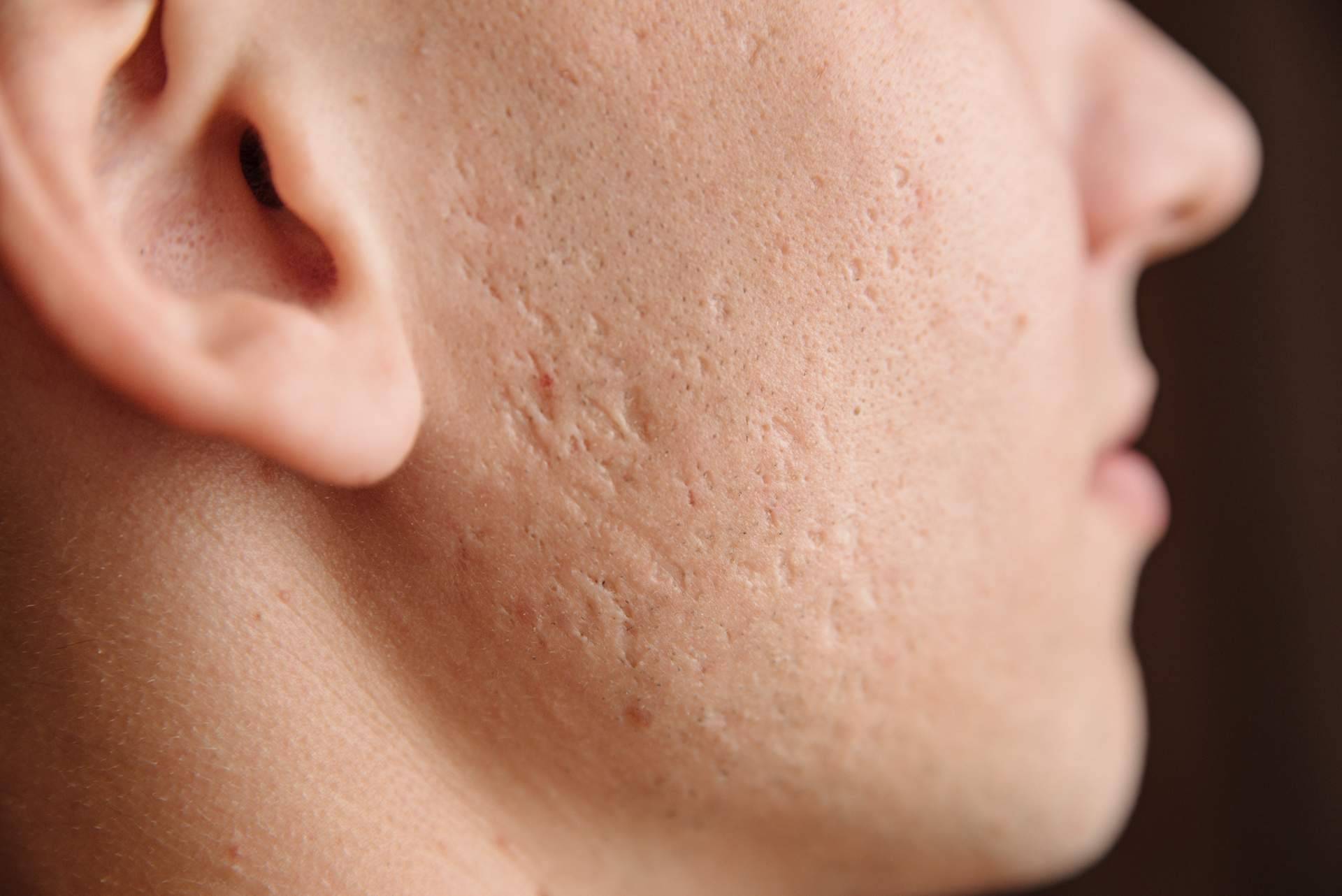 Tratamiento de cicatrices de acné con radiofrecuencia fraccionada con microagujas, de la mano de Alluring Clinic