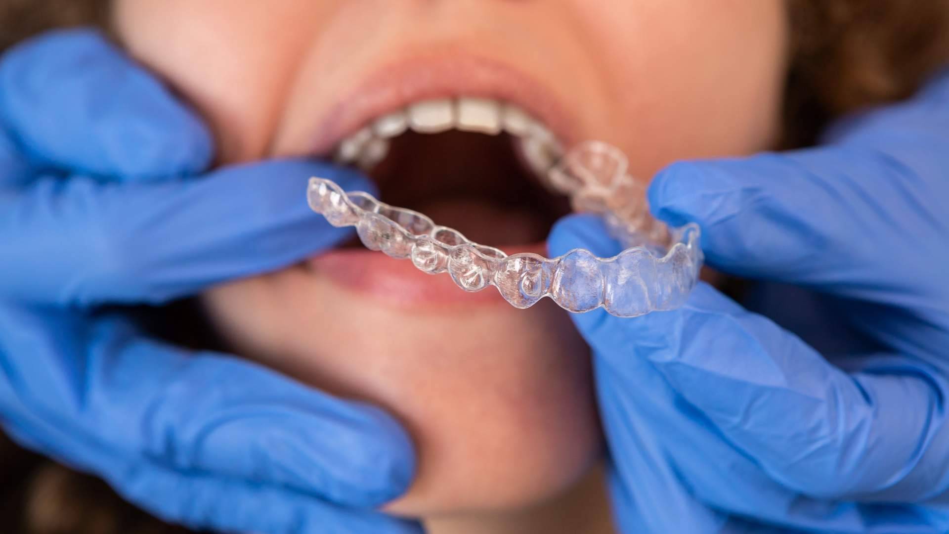 Clínica Dentinos, expertos en tratamientos de ortodoncia invisible en Málaga