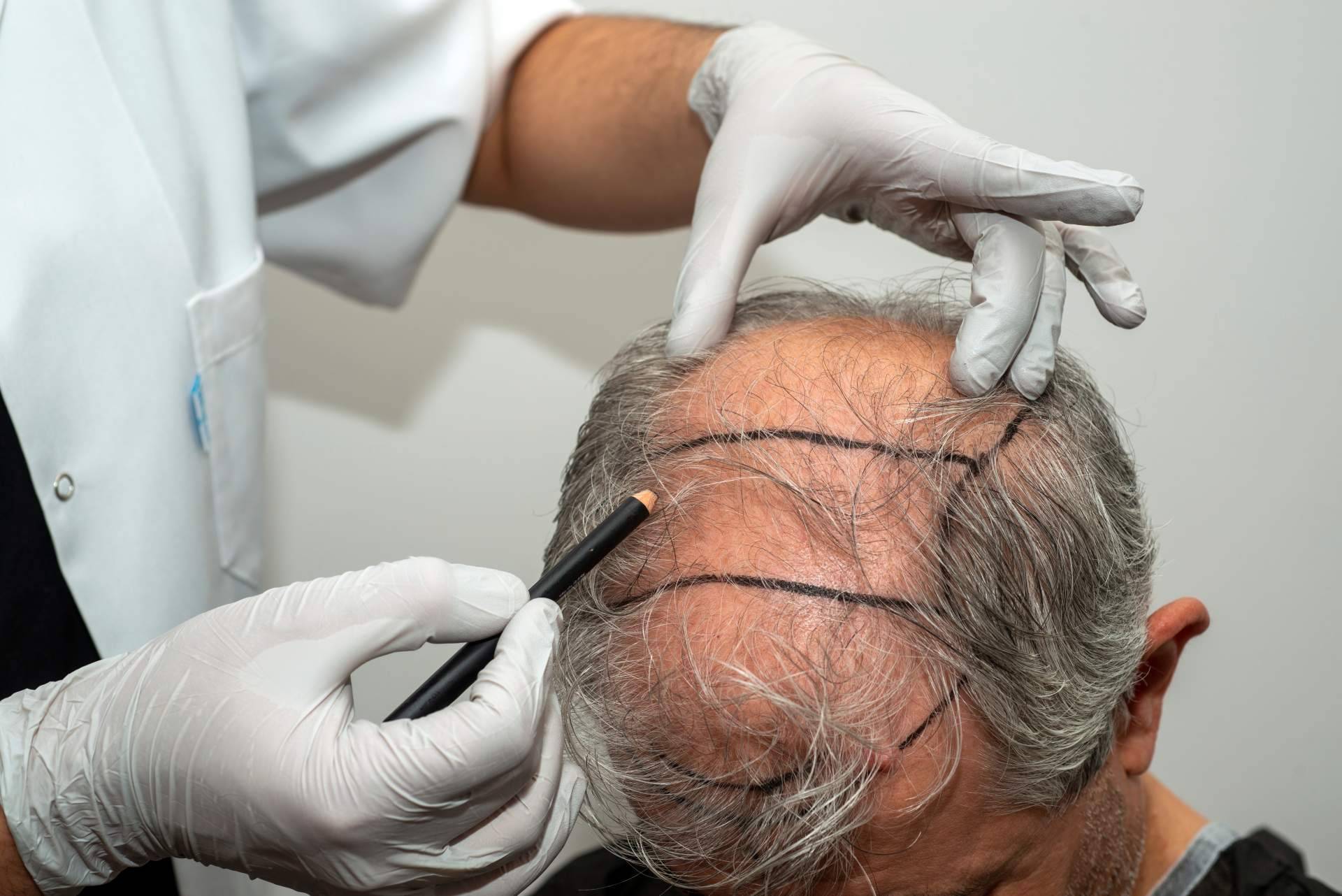 Microinjerto capilar FUE, solución definitiva y mínimamente invasiva para quienes sufren alopecia androgénica