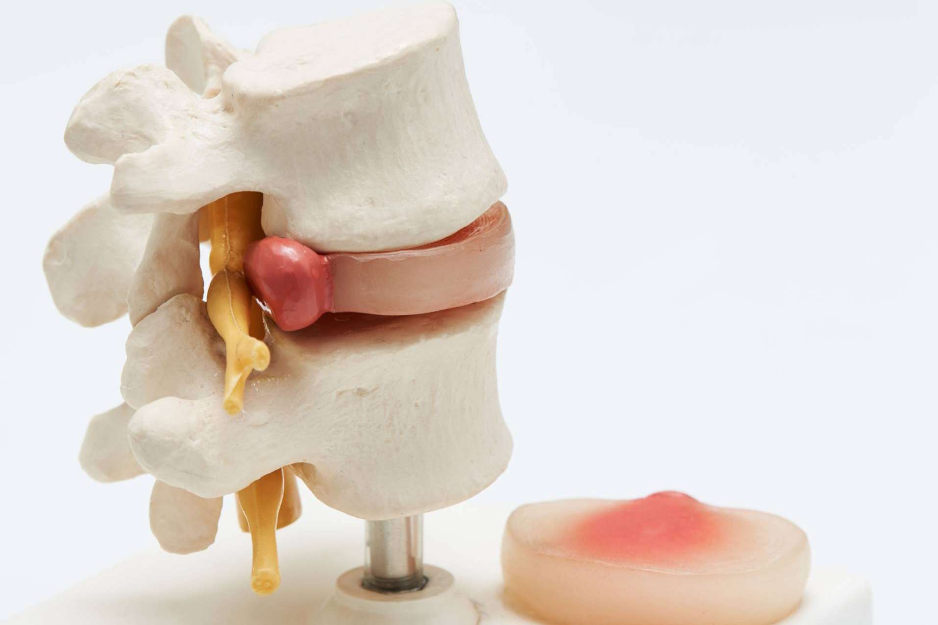 Tratar la hernia discal con andulación, un novedoso enfoque terapéutico