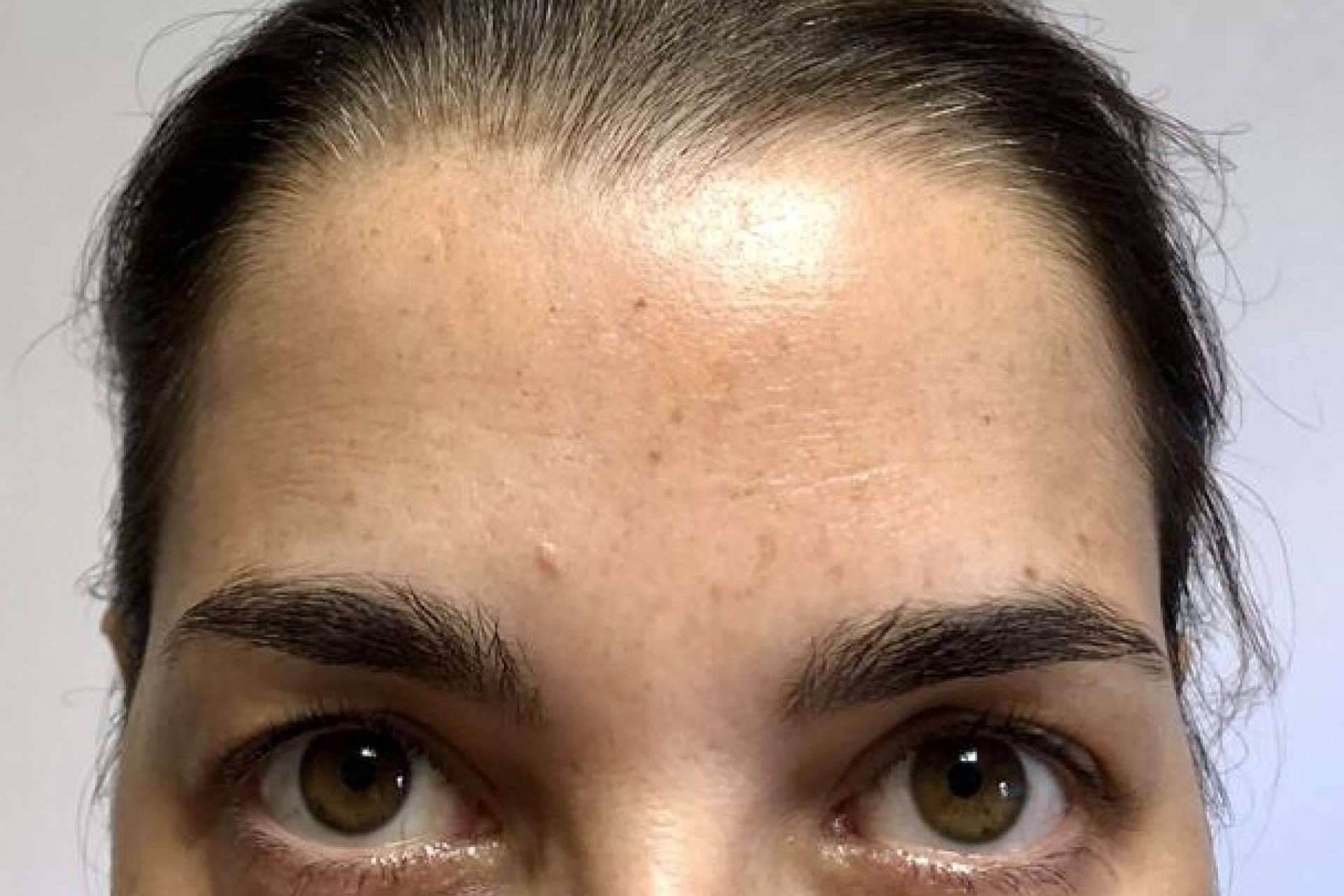 Un aspecto joven y natural con el tratamiento de rejuvenecimiento facial de Clínica Amalfi