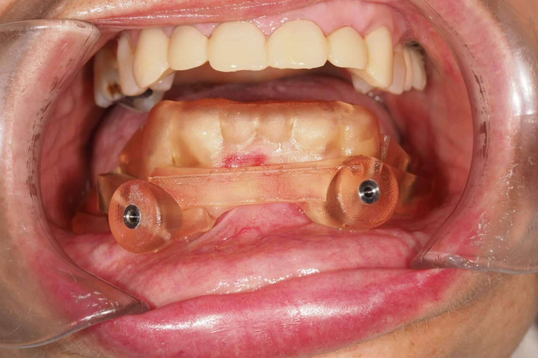 Centro Nacional de Cirugía Bucomaxilofacial e Implantes aplica implantes dentales en los casos más complicados