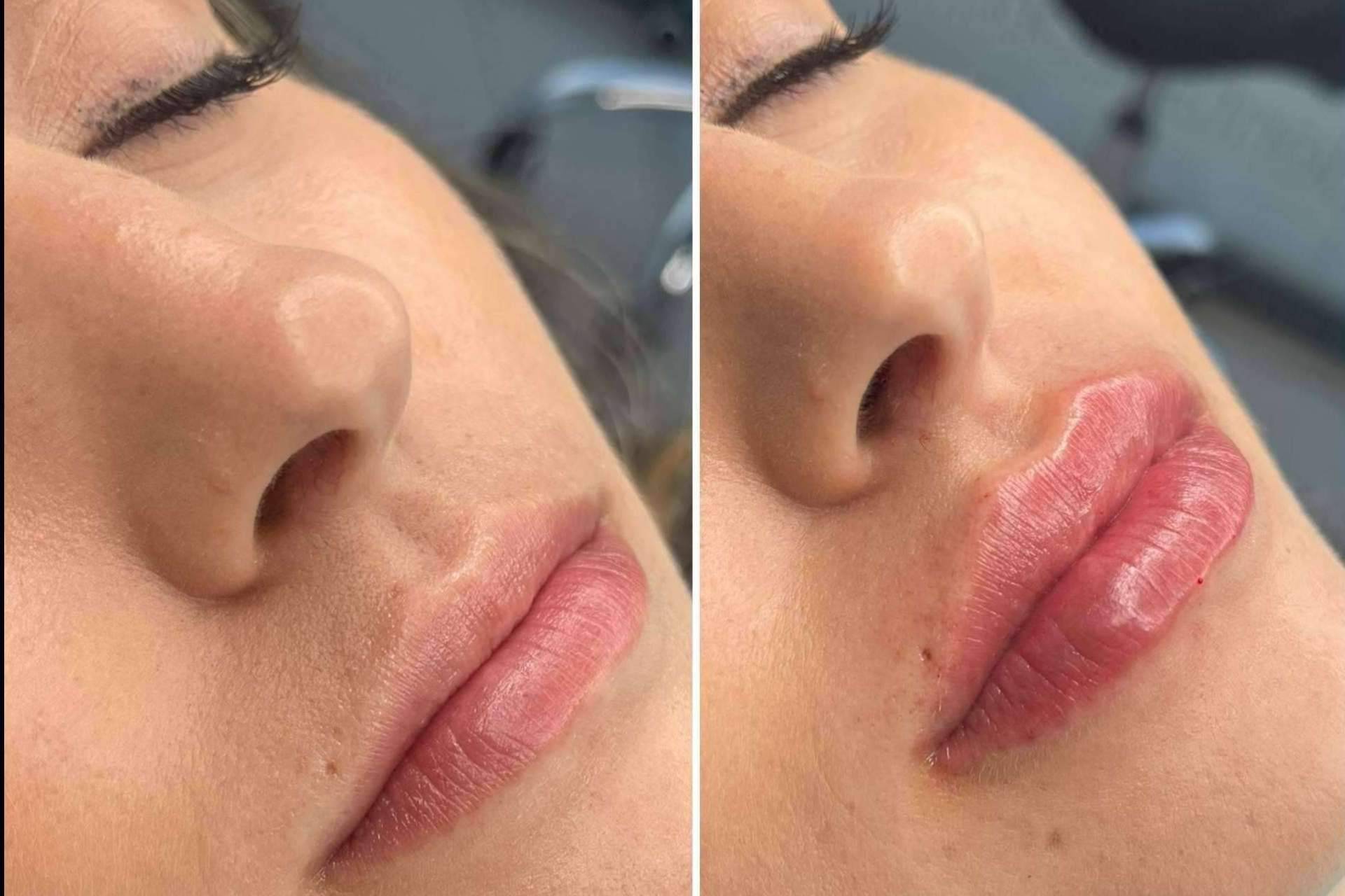 Clínica MG Dental & Estética Facial, profesionales en vial ácido hialuronico labios