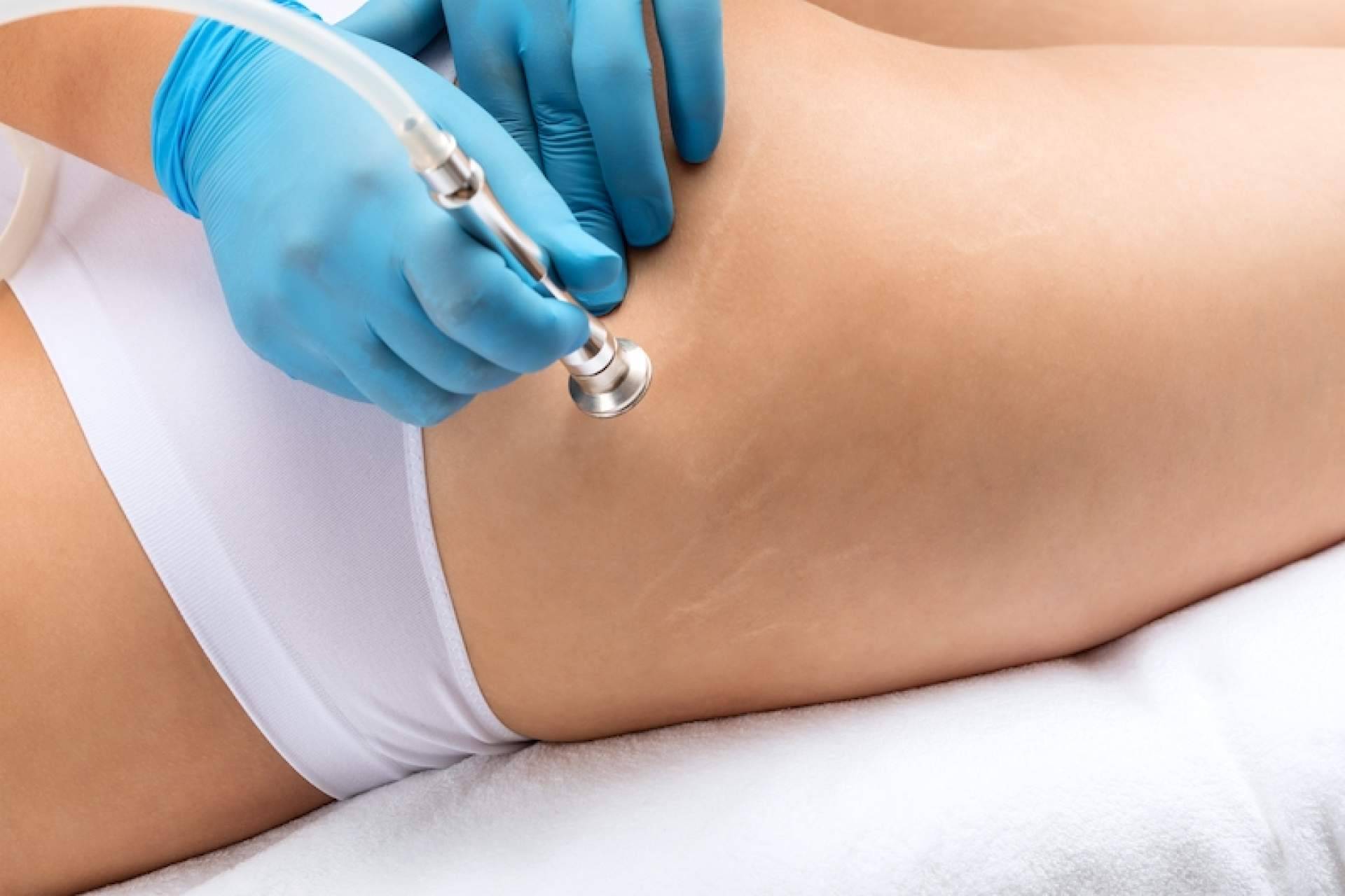 Las ventajas de eliminar estrías de la mano de la Clínica Estética Pilar