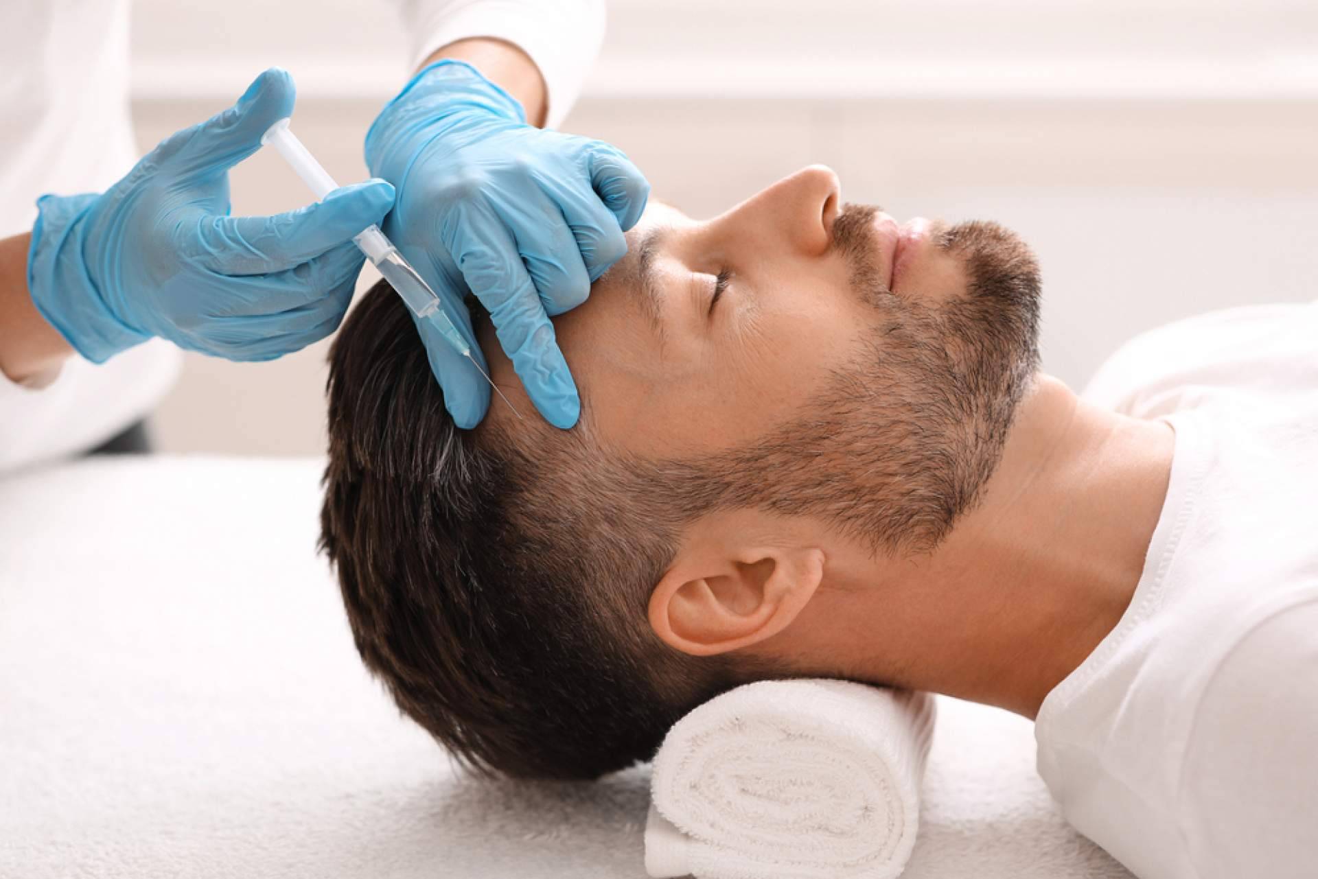 Mesoterapia capilar, una terapia sin cirugía que ayuda a combatir la pérdida del cabello