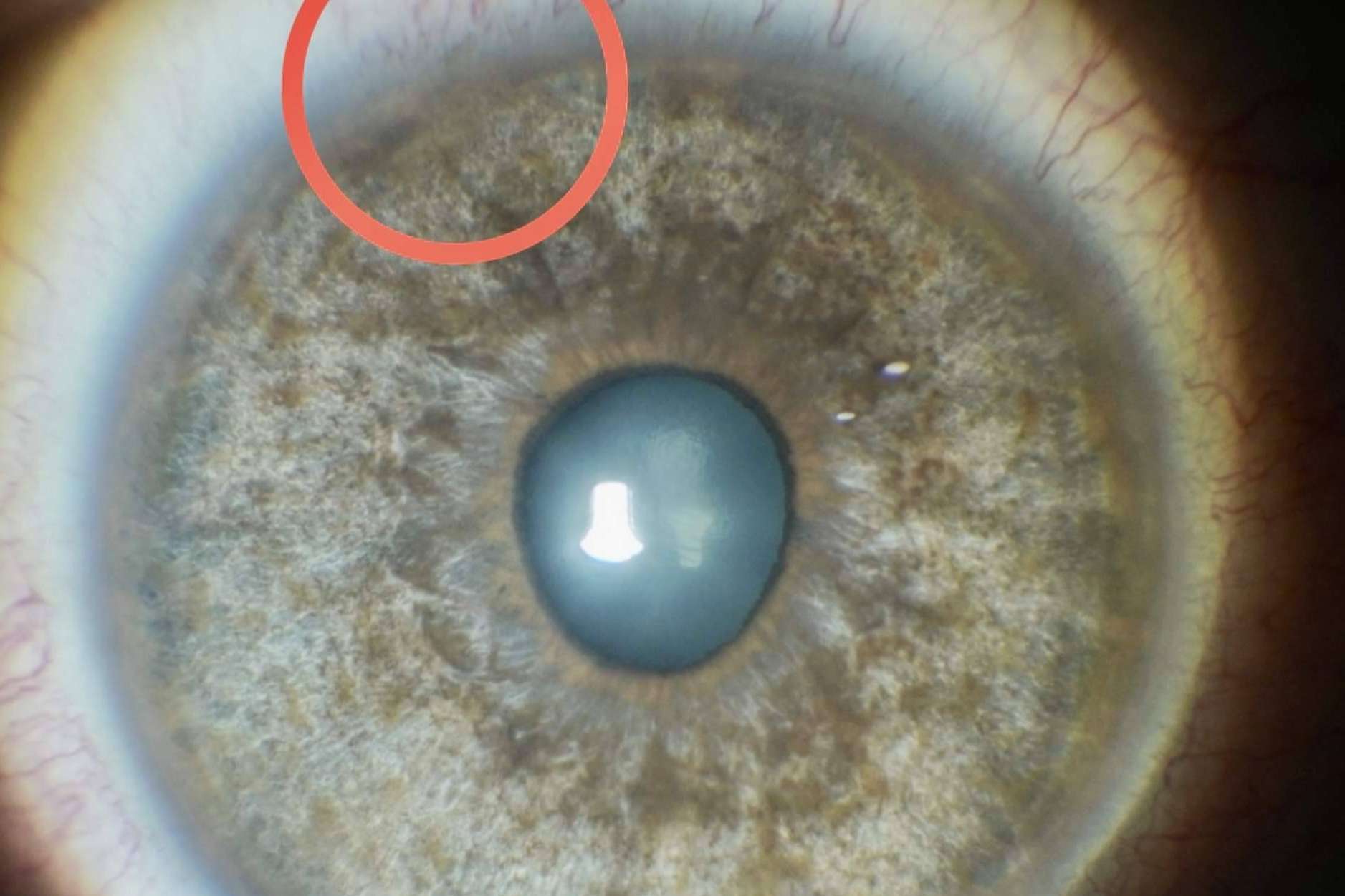Cómo funciona el tratamiento láser de las manchas pigmentarias de la conjuntiva