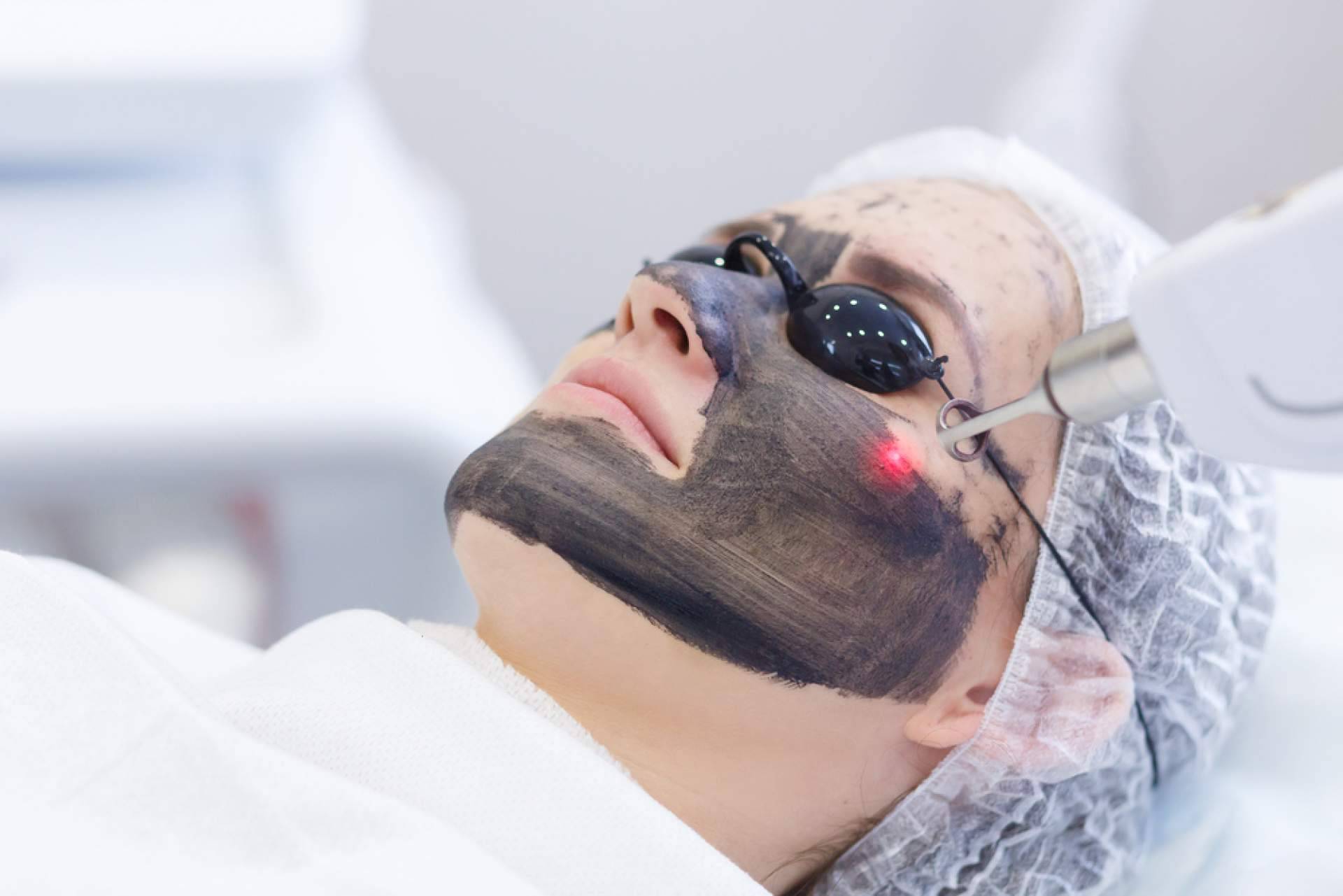 Los beneficios del carbon peel, con Crina Rus Beauty Center