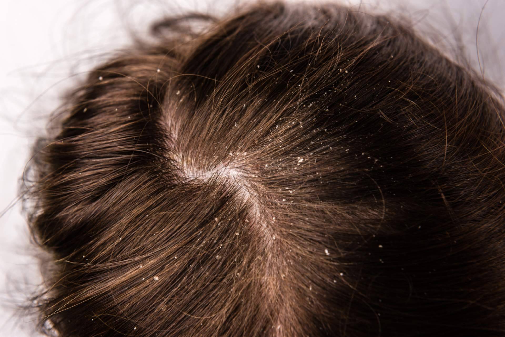 Los beneficios de realizarse un peeling capilar con Malecare