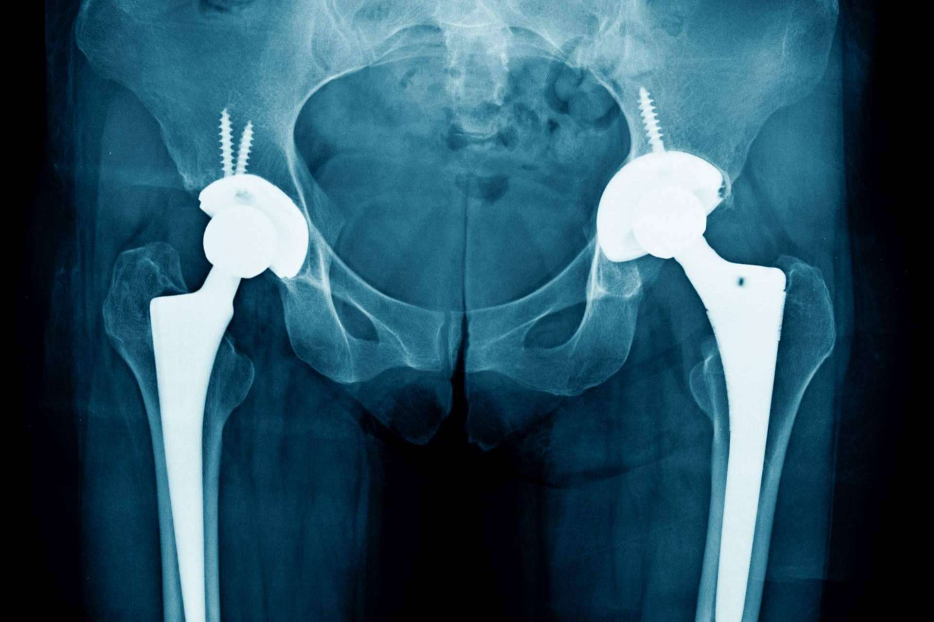 Descifrar el dolor y comenzar el abordaje de la artropatía degenerativa utilizando iXalud